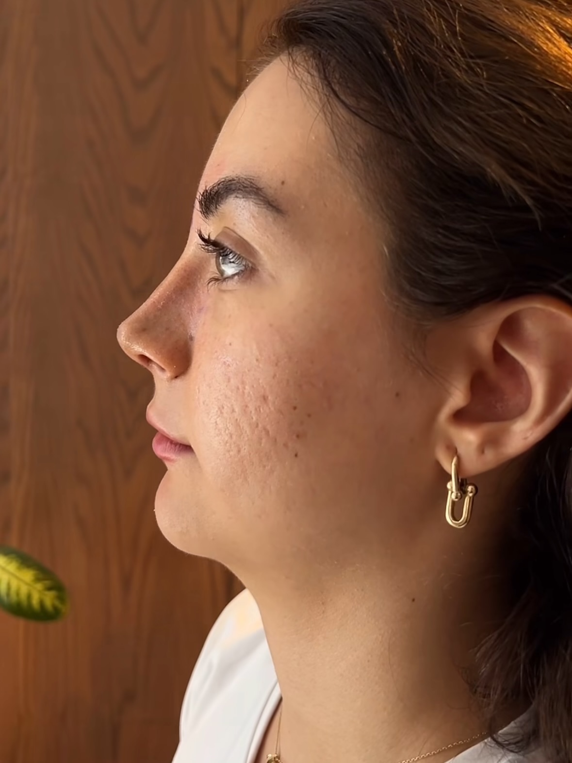 Gyönyörű forma orrplasztika után.❤️🔥
Az orrplasztika nem csak az arc arányairól szól.
Hanem az önbizalomról.
Arról az érzésről, amikor végre azt látod a tükörben, amit belül is érzel.
Természetes forma, harmonikus vonások.
Nem más lett – önmaga lett, csak felszabadultabban.
Az igazi átalakulás mindig belül kezdődik.❤️
📩 Kérdésed van a folyamatról vagy a beavatkozásról? Írj nekünk privátban vagy jelentkezz konzultációra elérhetőségeink egyikén!
✉️info@esteworld.hu
🌐www.esteworld.hu
☎️+36704323632
(Viber, Whatsapp és iMessage)
Bátran hívjatok hétköznapokon 10:00-től 16:00-ig.
#esteworld #esteworldmagyarorszag #orrplasztika #piezo #nosejob #rhinoplasty