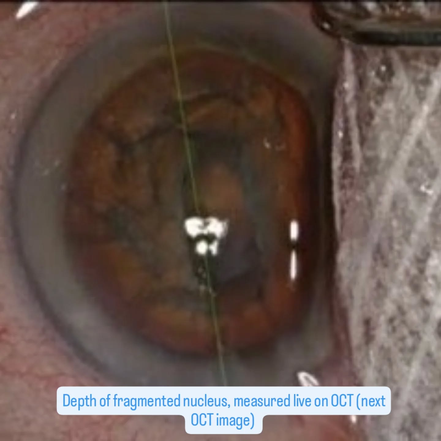 A true game changer has finally arrived.
After 2 years of anticipation, the first full-digital surgical microscope with integrated dynamic OCT, developed by Heidelberg Engineering and Bausch and Lomb, has entered the operating room — for the very first time in real clinical surgeries as part of a clinical study.
Image quality
OCT dynamics
Depth of field
Absolutely stunning!!!!!
This technology is set to revolutionize anterior segment surgery:
🔹 Corneal transplants
🔹 Phakic IOL implantation
🔹 Cataract surgery
🔹 Glaucoma surgery
🔹 Anterior segment reconstruction… and much more.