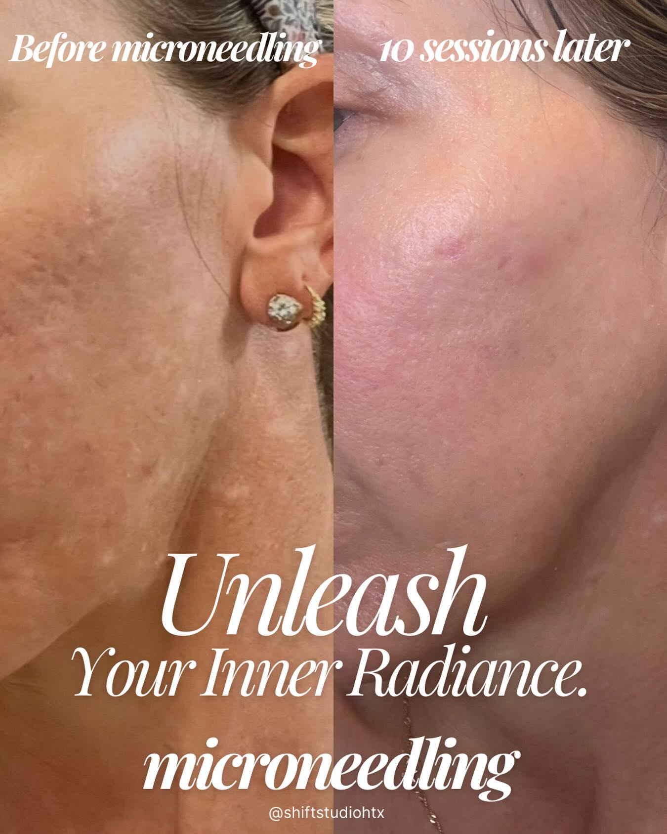 This is me. Summer 2024 → now.
No filters. No fillers. Just commitment.
Before microneedling, my skin showed:
• Uneven texture + roughness
• Old acne scarring
• Sun damage + discoloration
• Thinning, crepey skin
• Loss of firmness and collagen
• Chronic dullness despite “good skincare”
In August 2024, I made a decision:
I committed to consistent microneedling—done correctly, done regularly.
The changes?
✨ Happened quickly
✨ Continued month after month
✨ And are still improving
Why microneedling works:
It creates controlled micro-injuries that signal your body to produce new collagen and elastin. This is true regeneration—not camouflage.
When we layer strategically 👇
➕ Sculptra → long-term collagen stimulation
➕ PRN / exosomes → cellular communication + repair
➕ Peptides → healing signals that amplify regeneration
These aren’t “add-ons.”
They’re biological accelerators—working with your body’s own healing mechanisms.
Why microneedling is one of the most cost-effective treatments:
• Treats texture, tone, laxity, pores, scars
• Results compound over time
• No overfilled or artificial look
• Safe, predictable, and customizable
But recovery is everything.
What made the difference in healing + results:
➕ Invo Regenerative Serum
A true post-needling powerhouse—supports cellular repair, reduces inflammation, accelerates healing, and enhances collagen signaling so results are stronger and safer.
➕ Epicutis Lipid Serum
Critical for barrier restoration. Calms inflammation, prevents transepidermal water loss, and allows skin to heal without irritation—especially after needling.
➕ Epicutis Hyvia Crème
Deep hydration + barrier repair. Keeps post-treatment skin nourished, resilient, and protected so collagen can form properly instead of being disrupted by dryness or inflammation.
Microneedling isn’t a trend.
It’s science-backed, biology-driven, and proven—especially when recovery is respected.
Your skin already knows how to heal.
We just give it the right signals.
📍 @shiftstudiohtx
📆 Consistency > intensity
Not medical advice. Individual results vary.
#skinpenmicroneedling
#exosome
#invoaesthetics
#epicutis