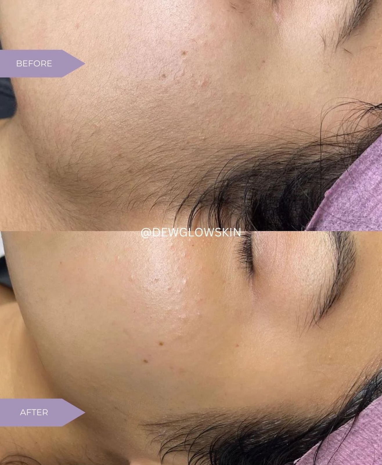 Dermaplane results you can see—and feel.
Dead skin + peach fuzz removed to reveal smoother, brighter, more refined skin instantly. No downtime. No harsh exfoliation. Just real results.✨
✔ Not shaving
✔ Hair doesn’t grow back thicker
✔ Performed by a licensed esthetician
📍 Snellville, GA
🔗 Book your ℙ𝕖𝕒𝕔𝕙 𝔽𝕦𝕫𝕫 𝔾𝕠 facial. Link in bio.
.
.
#dermaplane #dermaplaningfacial #snellville #glassskin #atlfacials