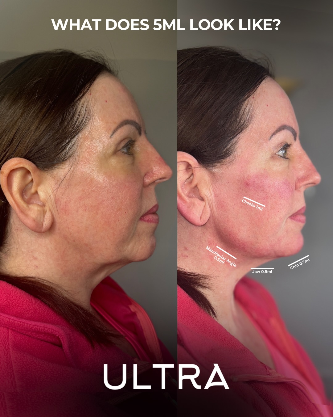 WHAT DOES 5ML LOOK LIKE? 👆🏻
This is exactly why we always say it’s not about overfilling!
It’s about placement, balance and restoring volume loss.
In this treatment we used 5ml in total to lift, define and restore structure in the right places (cheeks / jaw / chin), and you can see the difference it makes.
This lady still looks natural, still looks like herself - just totally refreshed, more youthful and defined.
3 out of our 5 spaces for our morel day Friday have gone, we have 2 spaces left for these heavily discounted treatments:
• PDO Threads
• Tox Lift Facelift
• Filler Lift - Define and Refresh Package (options for cheek, chin, jaw, lips)
Want one of the last spots?
DM for more info and to apply.
#LiverpoolAesthetics #FacialBalancing #facialrejuvenation #jawlinefiller