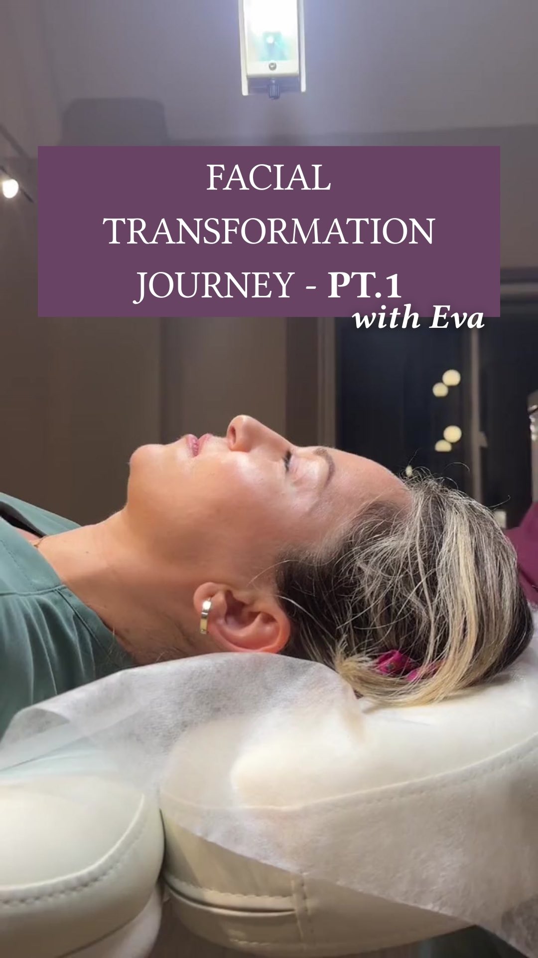 The first step in Evaās facial transformation.āØ
I treated her nose to straighten the bridge and lift the tip in order to refine the shape and improve the overall slope. First step of her profile enhancement complete! Using @precision.32 micro syringes š