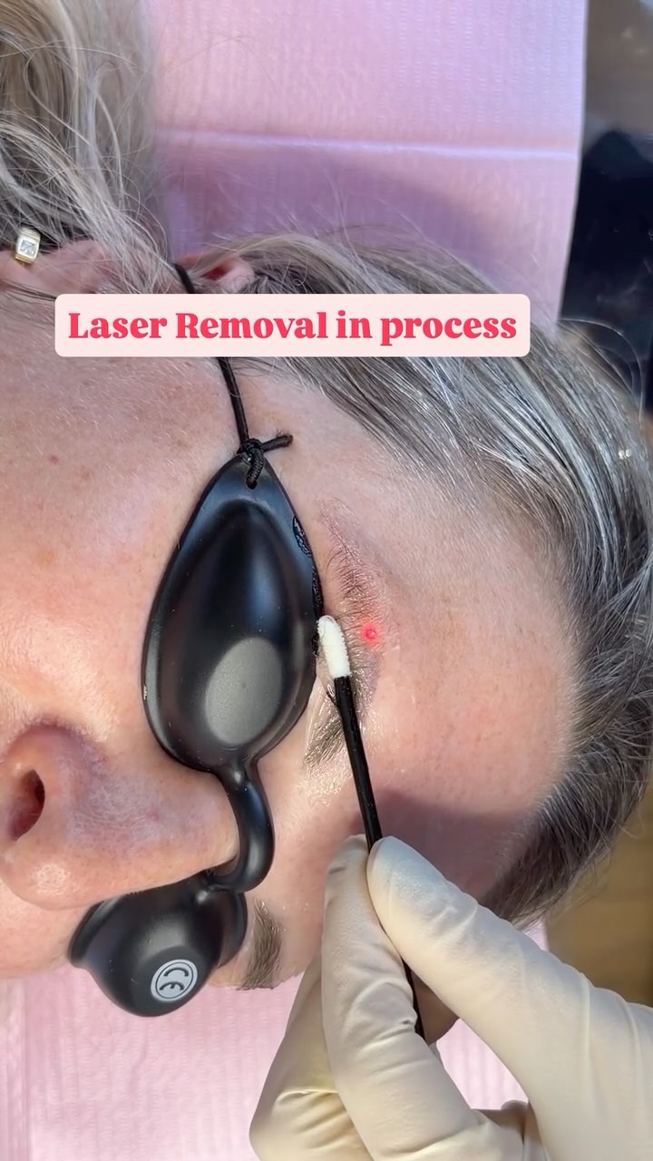 💁♀️2nd tattooed brow removal of the day💪💪! #laserremoval #cosmetictattooing #browtattooremoval! #wellington #cosmetictattooremoval