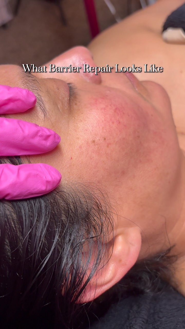 Nata, my face feels so sluggish and dull :(
Everything I do at home doesn’t work… WHY?! 😩
If you’ve read this far, there’s a high chance your skin barrier is impaired..
An impaired skin barrier means your skin can’t hold onto moisture or protect itself properly.
Instead of bouncing back, it stays dull, tight, inflamed, or reactive… no matter how many products you use.
When the barrier is compromised, the skin is stuck in survival mode. Exfoliating more won’t fix it.
Pushing harder won’t fix it.
The solution is restoring balance, hydration, and safety to the skin not forcing results.🤍
If your skin feels tired instead of resilient, it’s asking for repair, not more effort. 🤍
Book our Barrier Repair Facial | DM for booking.
#azesthetician#phoenixesthetician#azskincare#phoenixskin #dryskin