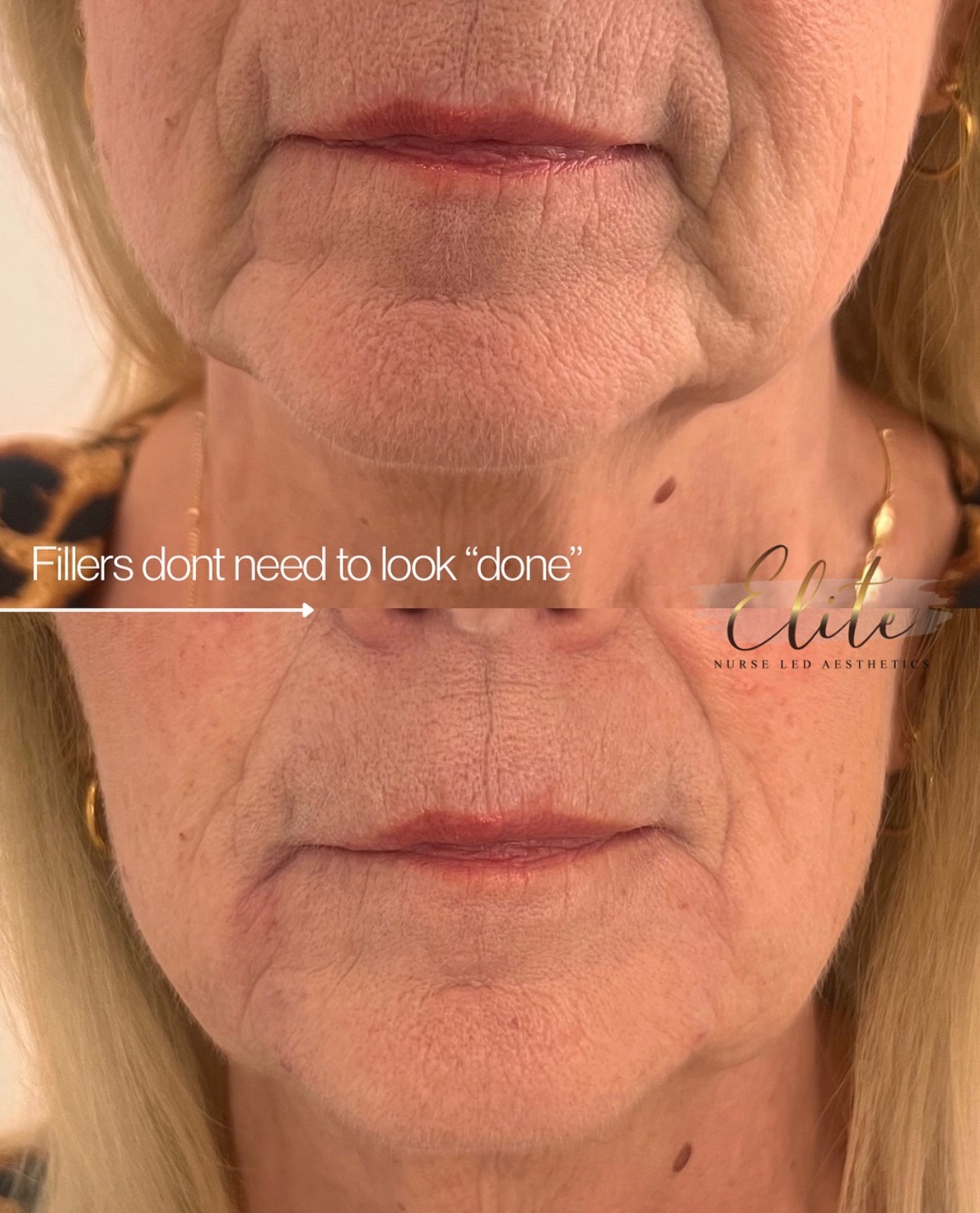 Fillers don’t need to look “done”
Marionette lines (the creases that run from the corners of your mouth down to your chin) can make us look tired, sad, or older than we feel. But with our expertly placed dermal filler, we can:
💉 Smooth deep folds
💉 Gently lift the corners of the mouth
💉 Restore a softer, more youthful appearance
✔ Quick treatment – usually under 30 minutes
✔ Immediate results
✔ Minimal downtime
📅 Book your consultation today and let’s get you looking as youthful and confident as you feel.
📍 Elite– Nurse prescriber-led aesthetics in Batley, West Yorkshire
📩 DM us or call 07596389971 to reserve your appointment