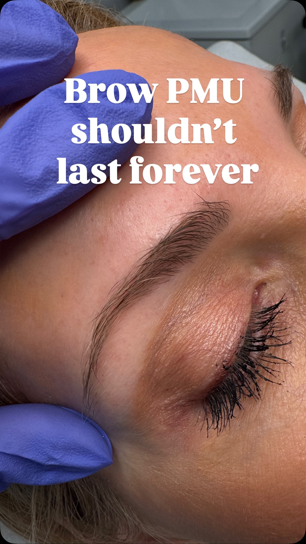 Permanent makeup is designed to fade softly, not stay dark forever—and that’s intentional.
When pigment is implanted at the correct depth, it heals lighter, more natural, and fades gradually with the skin’s natural renewal cycle.
If brow pigment is implanted too deep or the skin is over saturated with it, it doesn’t fade gracefully.
Instead, it can:
• shift to muddy tones
• lose definition
• start to look more like a traditional tattoo
Soft, controlled fading allows brows to be refreshed, adjusted as your skin changes, and kept looking natural over time.
These brows were done 2 years ago and faded evenly—no harsh edges, no color distortion.
That’s not pigment disappearing.
That’s healthy skin, correct technique, and long-term planning.
Natural now.
Refreshable later.
Timeless always.
#bostonbrows
#massachusettspmu
#eastontma
#westwoodma
#permanentmakeup
#pmubrows
#bostonpmuartist
#nanobrows
#microbladingboston