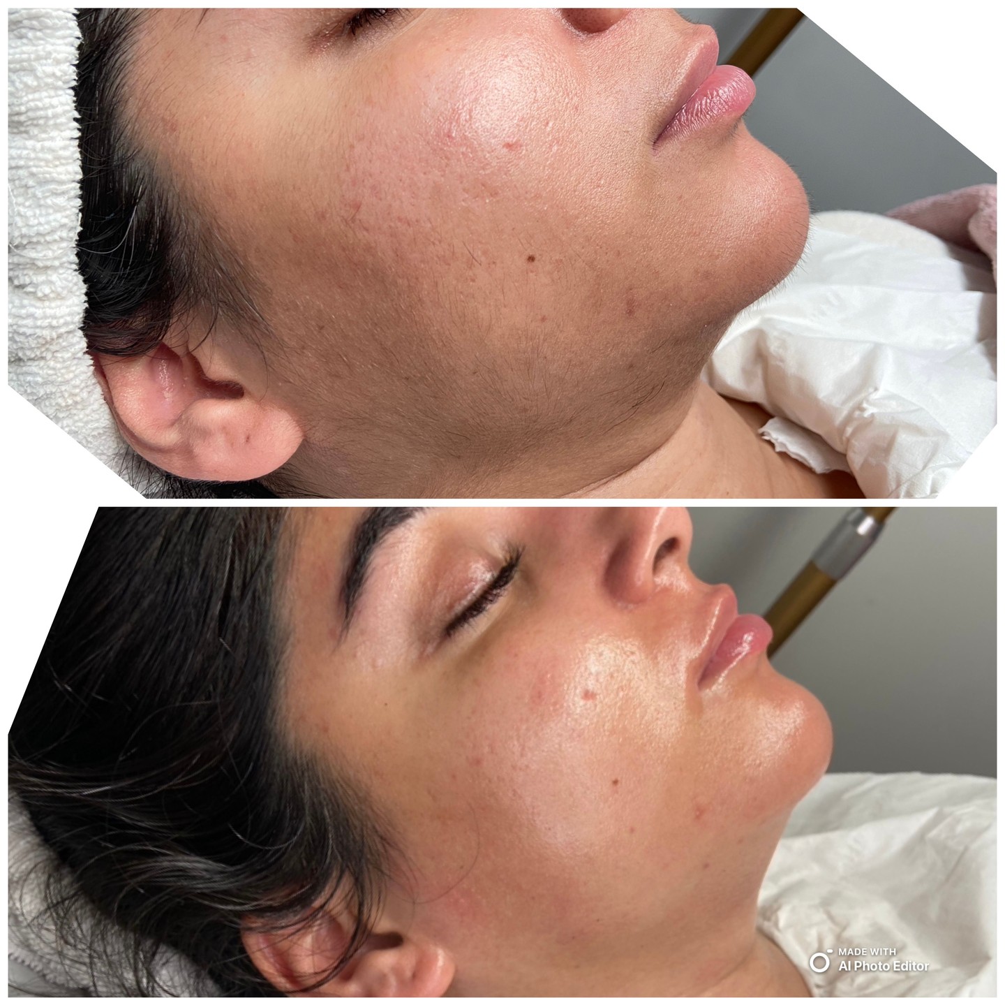 Real results. One radiant transformation at a time.
Ever wondered what a true skin glow-up looks like? See how advanced facials at Beauty by Naz can smooth, brighten, and restore your confidence. Our client came in hoping for a boost—and left with skin that glows from within.
"I never knew my skin could look this healthy. Naz made the whole experience so relaxing and pain-free. Now I can’t stop smiling!" ✨
Curious what’s possible for your skin? Book your consultation with Naz today.