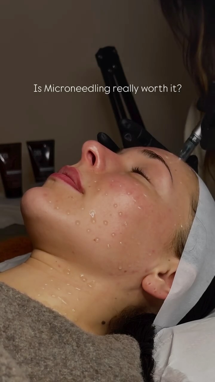 “Is microneedling really worth it?”
Short answer: Yes.
Long answer: Absolutely, and here’s why…
Microneedling (also known as collagen induction therapy) uses tiny needles to create controlled micro-injuries in the skin - sounds scary, but your skin sees it as a wake-up call.
✨ What happens next?
Your body jumps into repair mode, producing more collagen and elastin - the two proteins responsible for firm, plump, youthful skin. Over the next few weeks, your skin becomes noticeably smoother, firmer, and more even in tone and texture.
✨ What can it help with?
Acne scarring
Fine lines + wrinkles
Stretch marks
Large pores
Pigmentation
General dullness and skin texture
✨ What does it feel like?
Totally manageable. You’ll be a little red for a day or two after (think post-gym flush), but most people go back to normal activities the next day.
✨ Aftercare is key:
No makeup for 24 hours
Keep skin hydrated
Avoid sun, sweat, and activities for a few days
Use gentle, nourishing skincare
This treatment isn’t a one-off fix - it’s a game-changer for long-term skin health. Results build over time, and the more consistently you treat your skin, the better the results.
So… is it really worth it?
If you want real, lasting results - absolutely.
DM to book or chat about whether microneedling is right for you!
#microneedlingcheltenham #skintransformation #collagenboost #nineteenbeauty #skincliniccheltenham