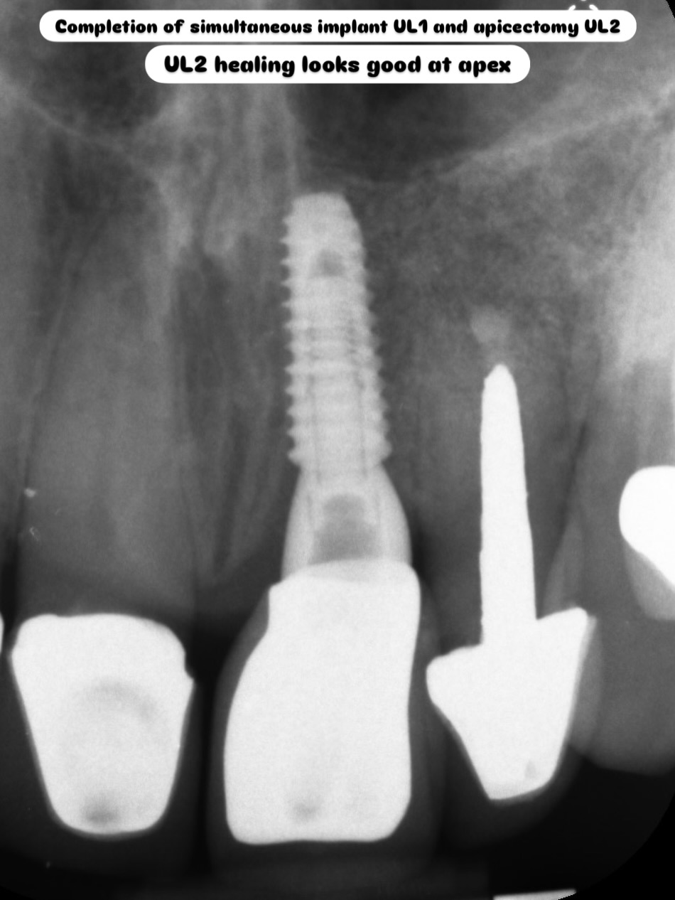 Final crown fit of a previous case with simultaneous apicectomy on UL2 and implant on UL1. #dentalimplants #apicoectomy #smiletransformation #dentaltreatment #osstemimplant
