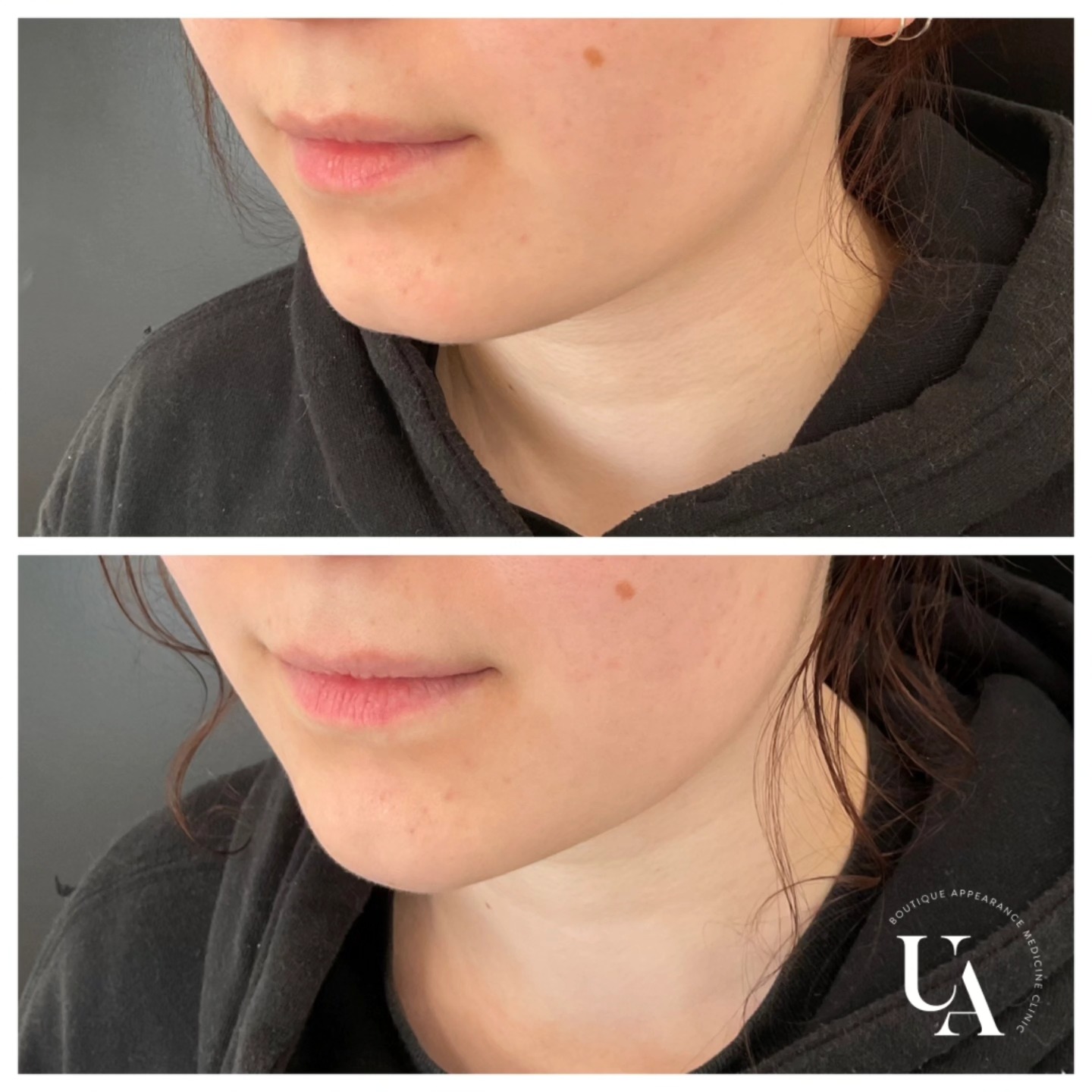 Balancing the facial features and enhancing natural beauty🥰❤️
#dermalfillers #antiwrinkle #beautiful #lovemyjobs #kapiticoast
Dermal filler injections are Medical devices for the treatment of loss of volume in the skin. Dermal fillers have risks and benefits. Ask your doctor if dermal filler injections are is right for you. For further information ask your doctor or go to www.medsafe.govt.nz