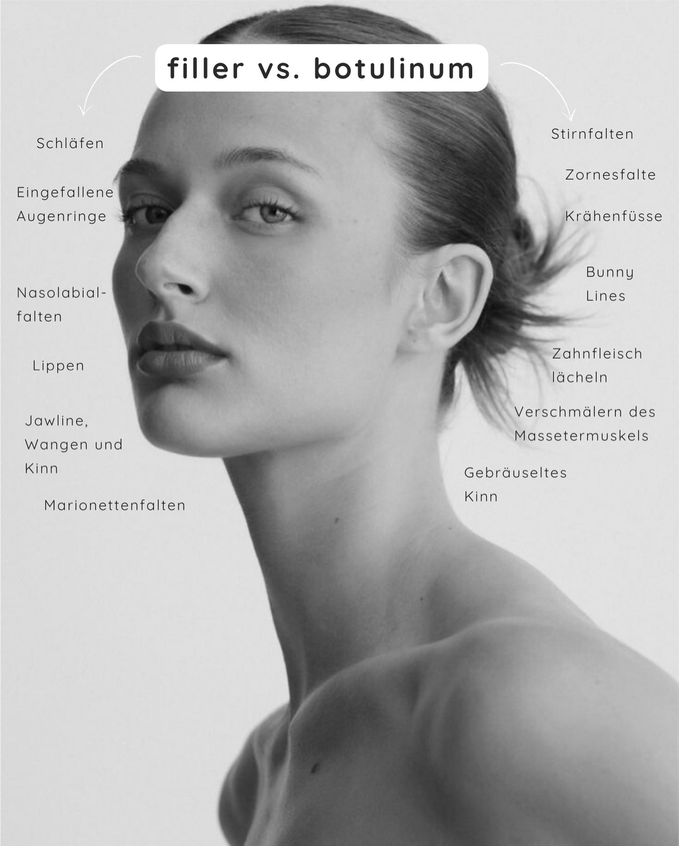 Wo wird Filler und wo Botulinum eingesetzt? Wir zeigen es dir. 👆🏼
Filler füllt Volumen auf, definiert Konturen und gleicht Falten aus.
Botulinum entspannt die Muskulatur, reduziert mimische Falten und beugt neue Falten vor.
Hast du eine Problemstelle und möchtest eine Empfehlung von uns? Melde dich für eine Beratung. 🗣️
#filler #botulinum #aestheticmed #nuaaesthetics