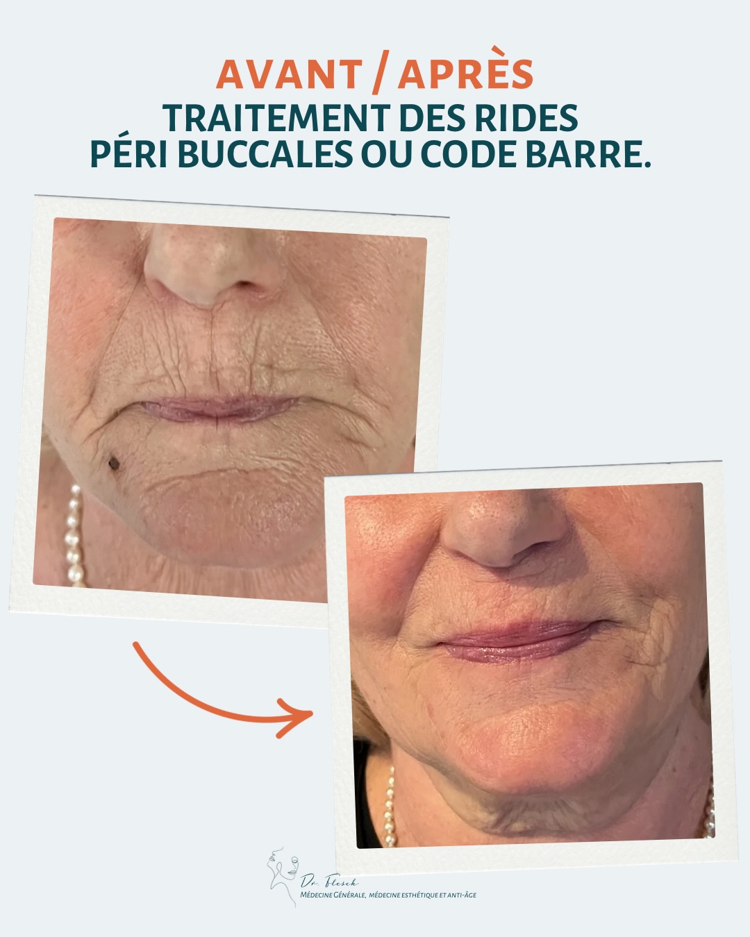 LIEN DE CONSULTATION :
Etiennette, 65 ans 🤍
Etiennette est une patiente hypertendue, ancienne fumeuse.
Après un divorce long et difficile, elle a décidé de “se faire belle”, pour se récompenser d’avoir traversé ces dernières années éprouvantes ✨
Sa demande principale concernait les rides autour de la bouche 👄
Nous avons donc travaillé par myomodulation et par une injection précise de la lèvre blanche, à l’aide d’un acide hyaluronique fin.
Mais cela n’a pas suffi.
Ses lèvres étaient très fines, son muscle mentonnier hypertonique, et les plis d’amertume bien marqués.
J’ai donc proposé de compléter le traitement dans un second temps, lorsque Etiennette s’est sentie prête 🤍
Parfois, on ne peut pas tout traiter d’un coup.
Il faut savoir respecter le rythme du patient, et avoir la sagesse d’attendre que la personne prenne elle-même conscience de la justesse de nos propositions 🌱
Aujourd’hui, Etiennette est ravie 😊
Elle se sent des ailes pour aborder une nouvelle page de sa vie, que je lui souhaite plus légère 🕊️