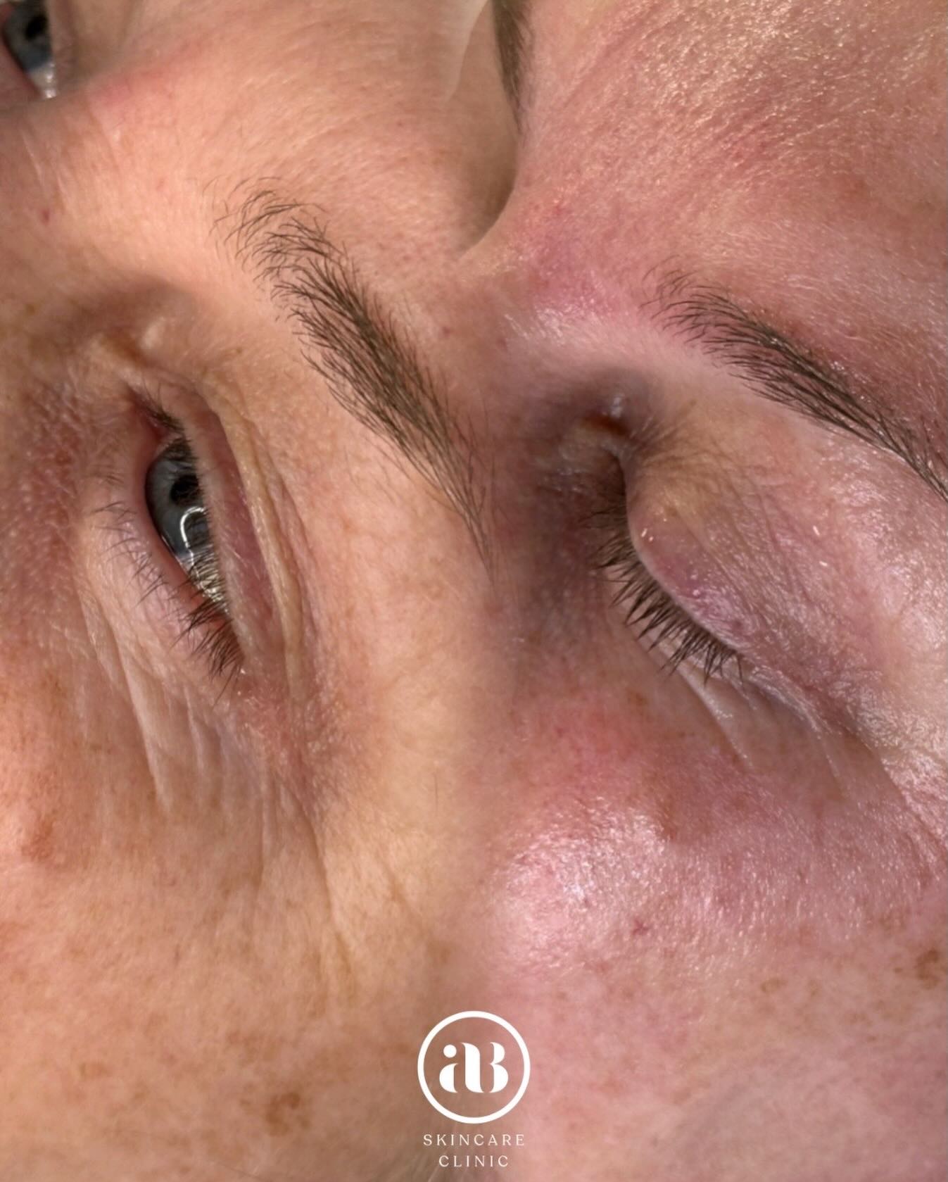 Advanced Microneedling Treatment โจ
This image highlights concerns around the eye area including fine lines, crepey texture and redness โ a delicate zone that requires precision-led care.
Microneedling stimulates collagen and elastin production, strengthening the skin from within to:
โข Smooth fine lines
โข Improve texture
โข Restore firmness
โข Enhance radiance
Paired with targeted clinical serums, results are progressive and long-lasting.
Clinically delivered results. โค๏ธโ๐ฅ
๐ Book your consultation today and experience expert-led skin rejuvenation.
#Microneedling #LuxurySkinCare #SkinClinic #CollagenTherapy #undereyerejuvenation