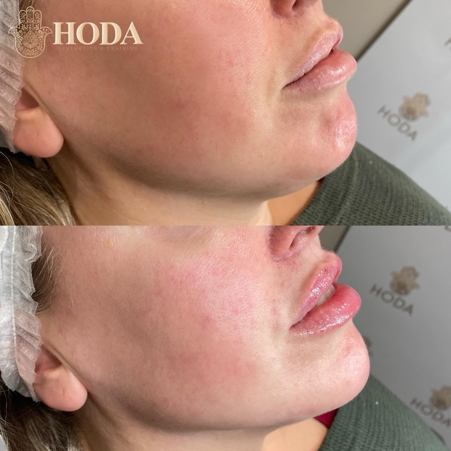Chin & Lip Filler Glow-Up ๐
Chin filler has quickly become one of our most popular treatments, and itโs easy to see why. A subtle tweak that makes a big difference, enhancing the profile and bringing beautiful balance to the lower face, with instant results and minimal downtime. We also treated the lips with a 0.5ml filler top-up for a soft, natural refresh ๐๐ฝ
๐ฒ DM book with Hoda
๐ฉ๐ผโโ๏ธ Nurse Led-Aesthetic Clinic
๐ Bournemouth, Dorset
#bournemouthaesthetics #chinfillerbournemouth #lipfillerbournemouth #dorsetaesthetics #facialfiller