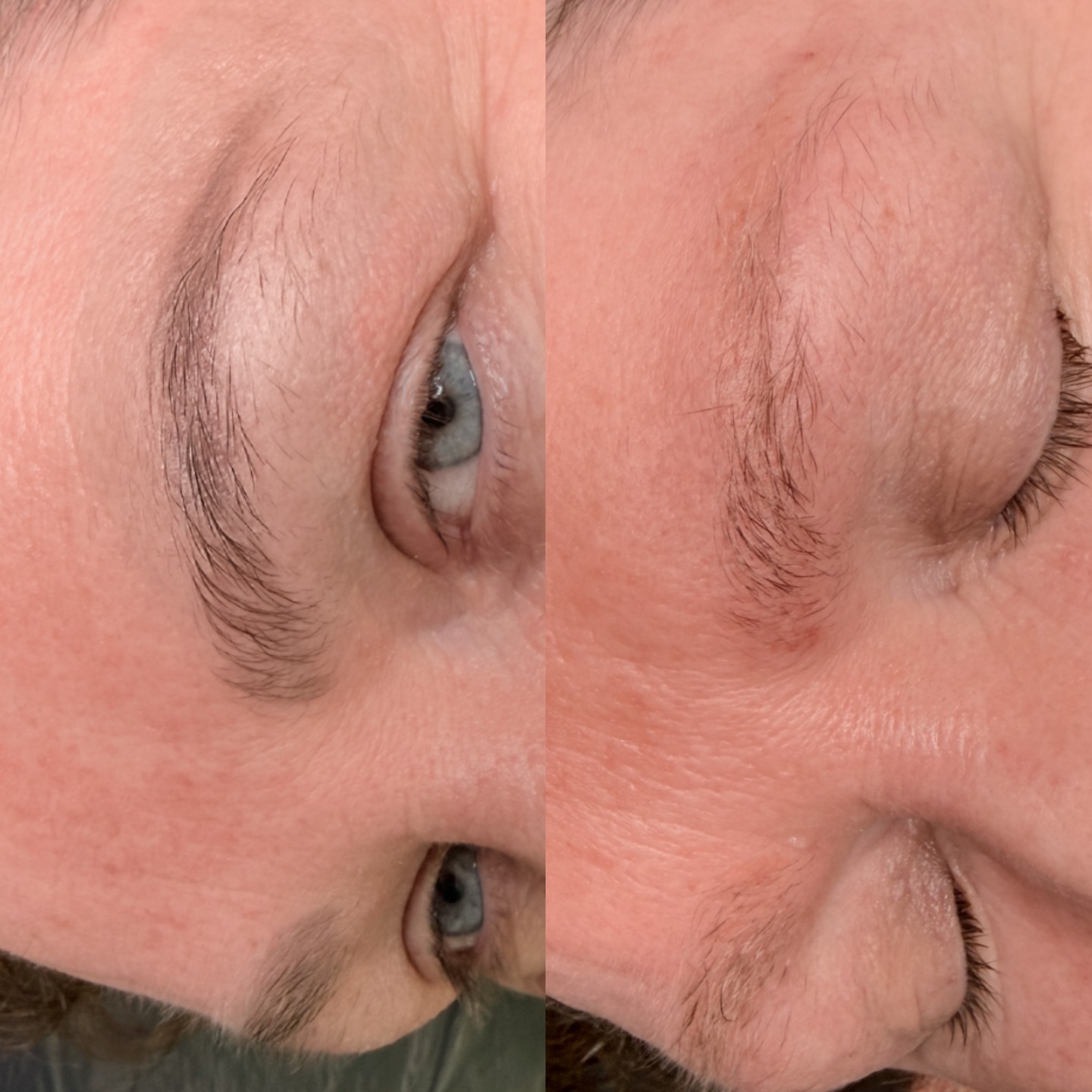 Immediately after one laser session ✨✨✨✨
Correct unwanted grey, ashy tones, blocky brows, or poor placement with advanced eyebrow laser tattoo removal!
Suitable for previous microblading or brow tattoo. My treatment is gentle, precise, and delivers amazing results after just one session 😍. Perfect for creating a fresh canvas for your dream hyper realism brows - whether you’re reshaping, lightening, or wanting to start over.
Trust the process. 1-3 is typical. See the results. Love your brows in 2026. 💖
#BrowLaserRemoval #BrowCorrection #FreshCanvas #FlawlessBrows #BrowTransformation #LaserRemoval #lasertattooremoval
For prices and live availability, please visit my website or drop me a message https://www.jorlittle.com/