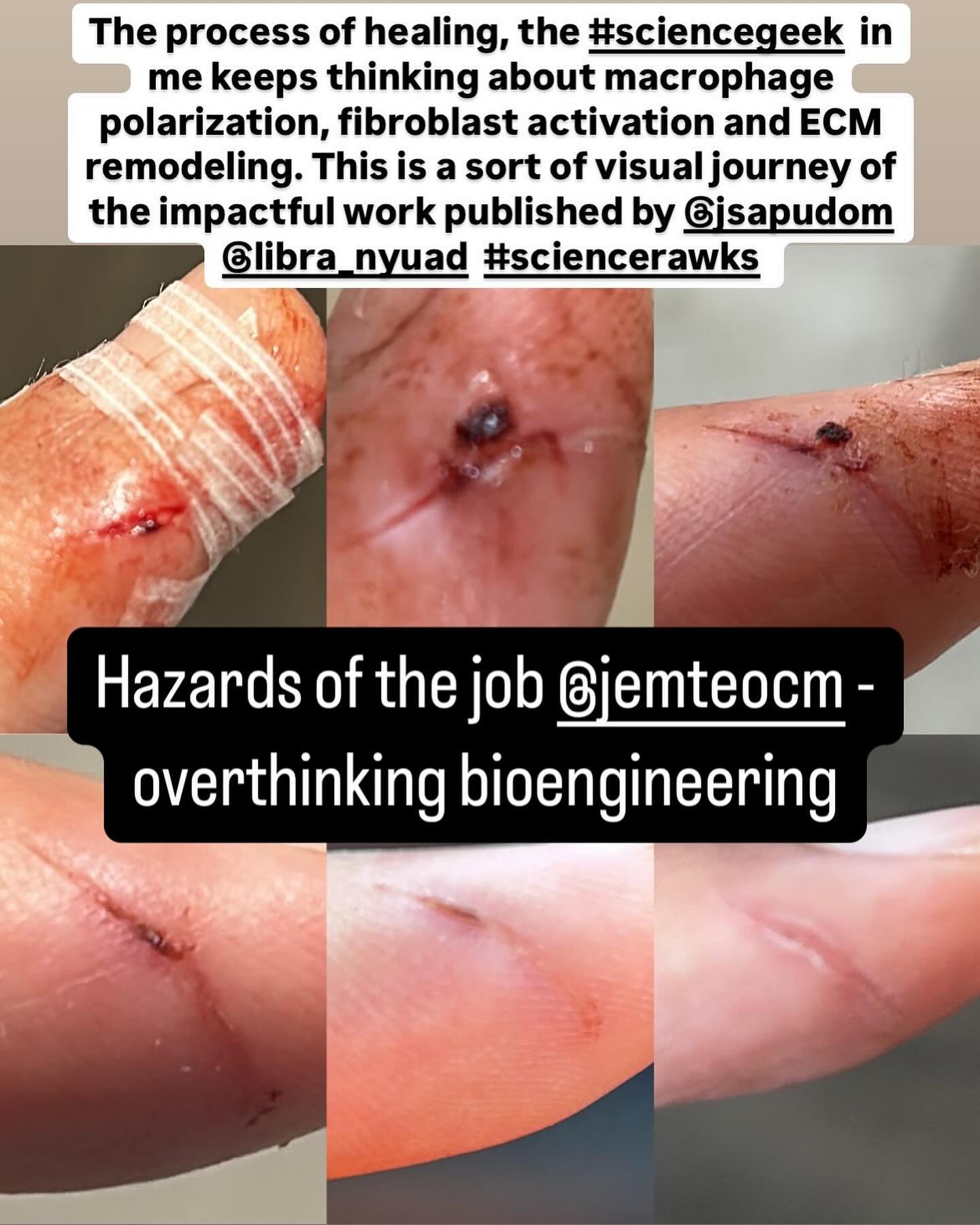 On tissue damage and insult and immune system kicks in. Clots are created to maintain haemostasis. Monocytes are drawn to the site and differentiates into macrophages. To get rid of the debris and other foreign antigens M1 macrophages sweep and clear the area for wound healing. M2a Macs then orchestrates fibroblast into action, activating them to be contractile. Myofibroblasts’s contractile mechanism draws the wound close, simultaneously remodelling the matrix, repairing the damage within. Finally the presence of M2c Macs signals the fibroblasts to revert back into their homeostatic state. Signalling and resolving the wound healing process.
Publications led by @jsapudom on macrophages
M1a/M2a: https://doi.org/10.3390/bioengineering7020033
M2a/M2c: https://doi.org/10.1038/s41536-021-00193-5 Fibroblast: https://doi.org/10.1002/advs.202301353