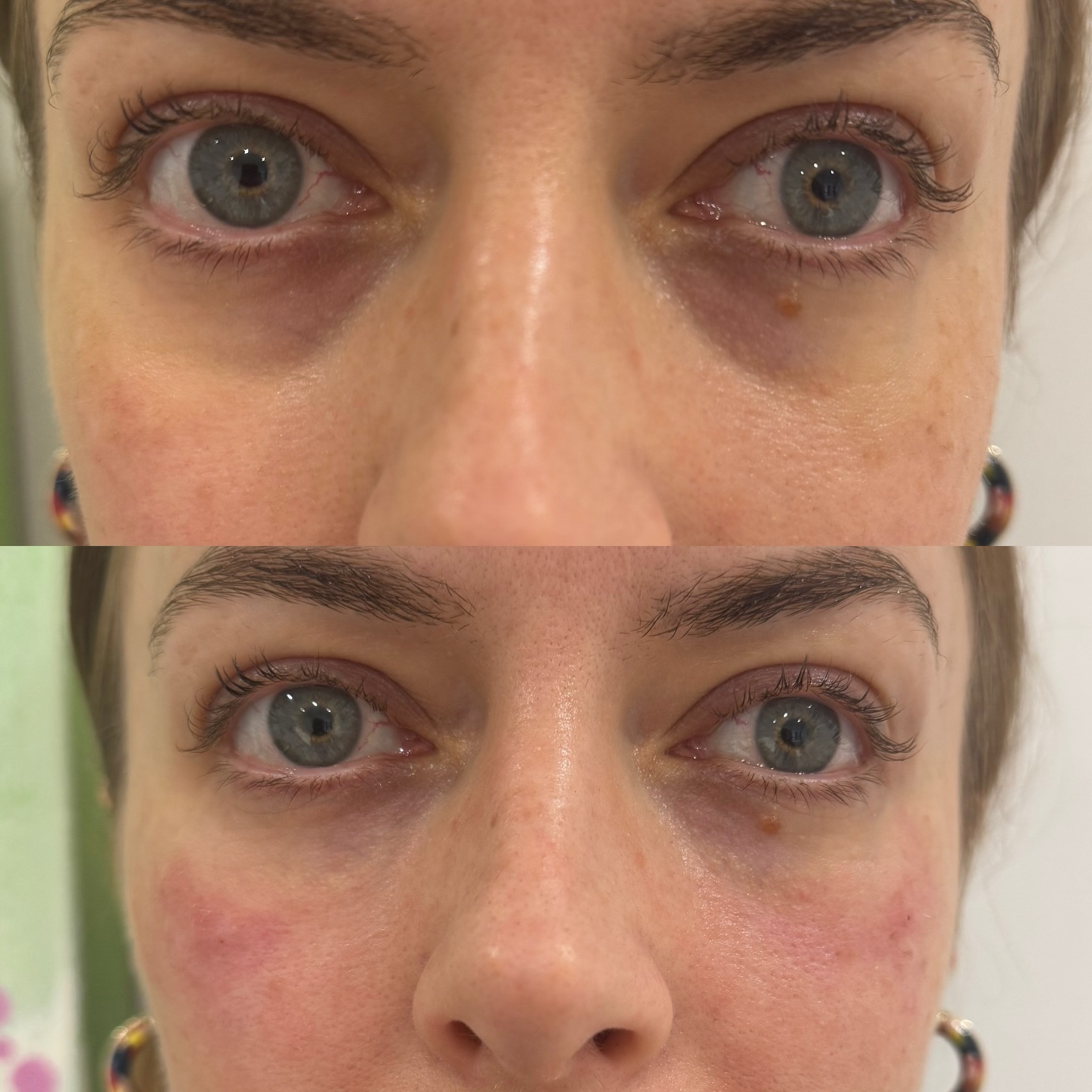 Let’s Talk Tear Trough Filler again 💉
Tear trough is the groove that sits in between the lower eye lid and the cheek. This hollowness starts to form when there is a loss of volume in this area which is usually as a result of weight loss or with age.
Dermal filler, created specifically for the under eye area, will fill in the hollowness and soften the appearance of the tear trough, thus creating a brighter look.
With every treatment we start with a consultation to understand what you want to achieve. With this non-surgical method, dermal fillers are injected into the area, adding volume beneath the under eyelids, making the skin look fuller and tighter, and with the skin a bit more stretched out, fine lines under the eyelids will be minimised, resulting in facial rejuvenation.
Consultation is key as there are other treatments appropriate for this area such as polynucleotides however it depends on the skin quality and the overall outcome one wants to achieve.
#facialrejuvenation #teartrough #dermalfiller #hampshirefiller #artyclinic
@simplyskinltd
@enalionbeauty
@newenergyyoga
@newenergyfitness
@winchesterracquetsandfitness