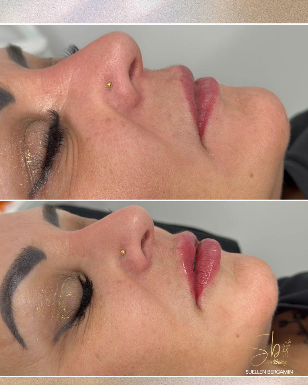 Preenchimento labial vai muito além do volume. 💉✨
Ele hidrata profundamente os lábios, melhora o contorno, suaviza pequenas assimetrias e devolve aquele ar jovem e descansado ao rosto.
Nada de lábios iguais aos de todo mundo ou exagerados!!
Cada resultado é único, assim como você. 🥰
Agende seu horário. 💋
+44 7398 192413
.
Lip filler goes far beyond volume. 💉✨
It deeply hydrates the lips, enhances definition, softens minor asymmetries, and restores that youthful, refreshed look to the face.
No exaggerated results or “one-size-fits-all” lips!
Each result is unique — just like you. 🥰
Book your appointment. 💋
📲 +44 7398 192413