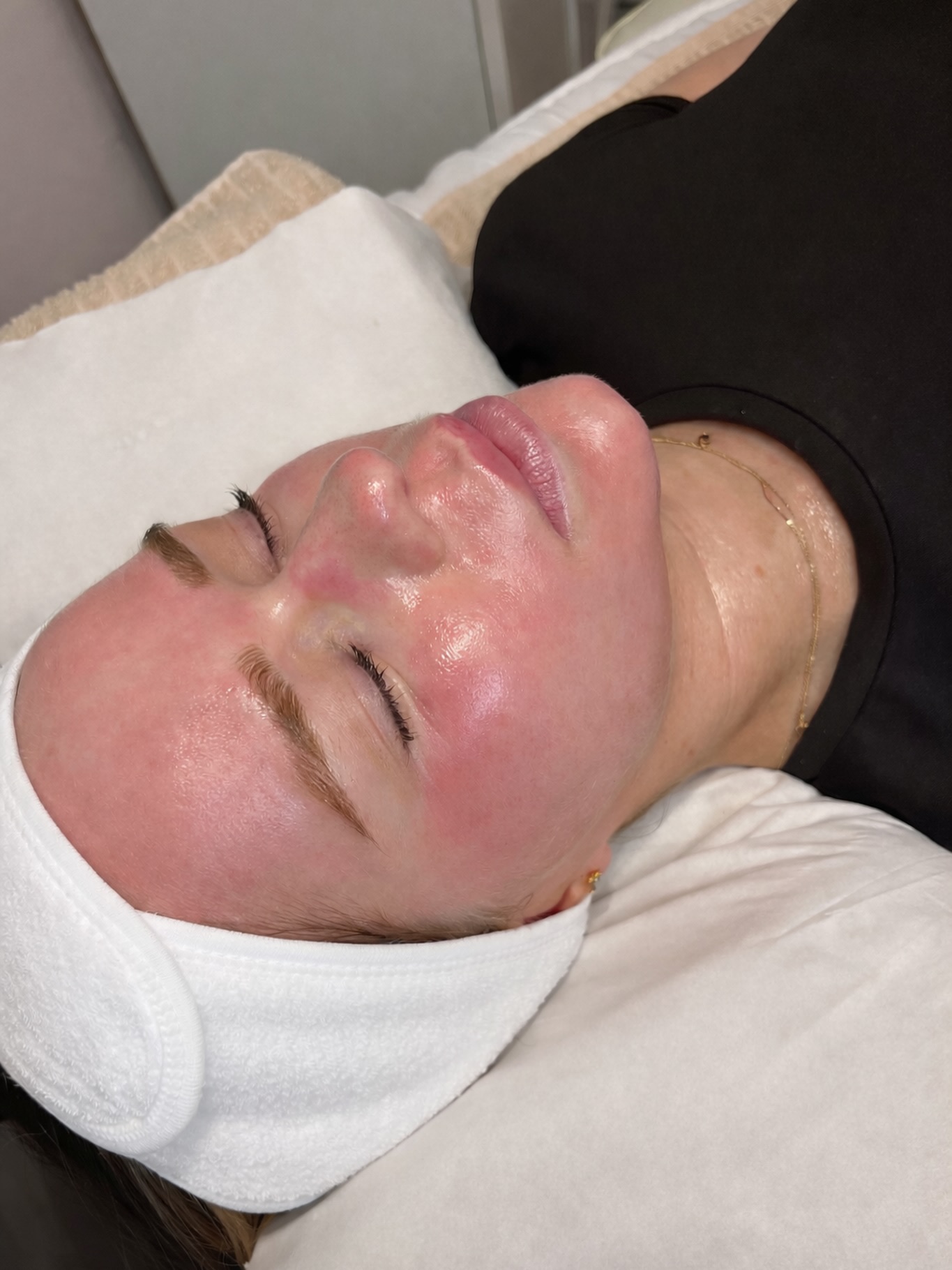 That Post-Microneedling Glow ✨
• Microneedling creates tiny micro-channels in the skin to trigger repair and renewal
• Allows up to 300% increased absorption of active skincare ingredients
• Stimulates up to 400% increase in collagen & elastin over time
• Improves texture, pores, fine lines, acne scarring & pigmentation
• Results build gradually — stronger, healthier skin from within
Redness is completely normal post-treatment and typically settles within 24–48 hours.
Summer skin is built in winter ❄️☀️
✨ £25 off microneedling when booked with Anna
📅 Booking must be made this month
Use code: GLOW2026 to secure your discount 💌
#microneedling #skinregeneration #collagenboost #glowyskin #skinconfidence