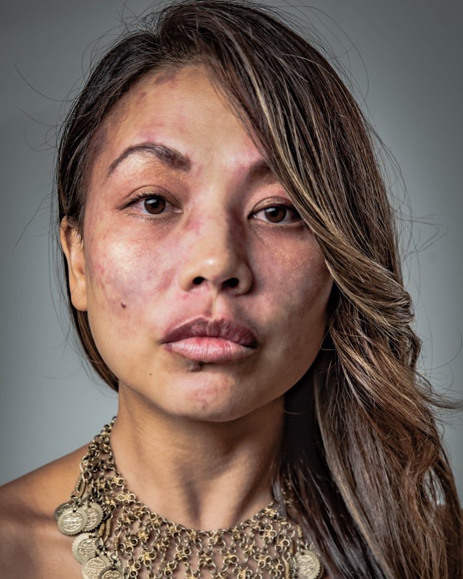 Birthmark or beauty mark? My port wine stain is a bilateral facial lesion. I also have it on the entirety of the back of my legs from my bum to the soles of my feet. This birthmark also covers parts of my internal organs, eyes, ears, and throat.
Beauty marked inside and out😉 #portwinestain #birthmark #fullcoveragefoundation #beautymarked