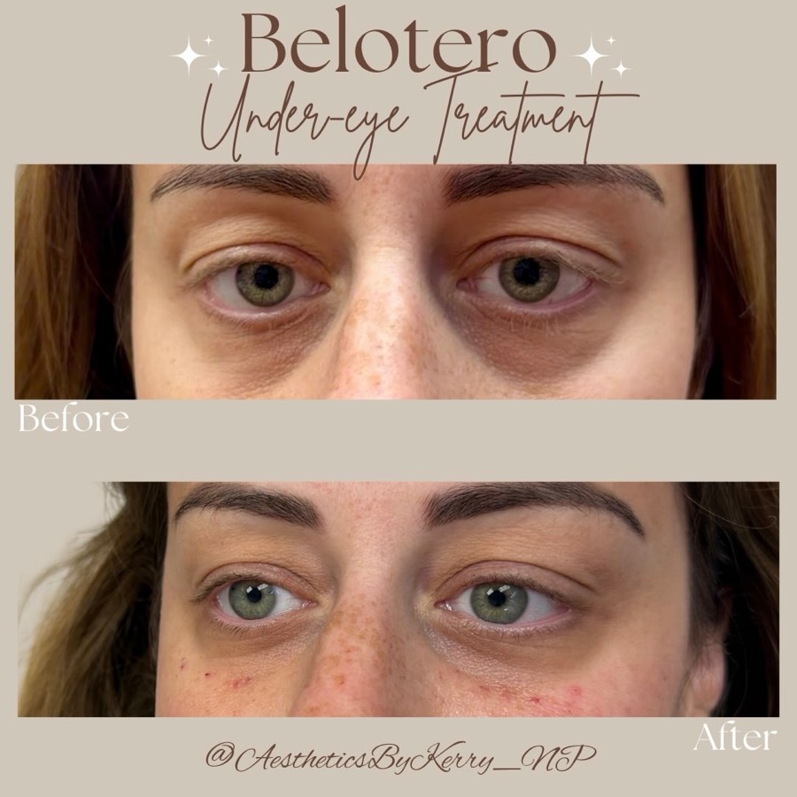 Not everyone is a candidate for under-eye filler — and that matters.
Assessment, anatomy, and product selection determine whether results look refreshed or overdone! ✨🤍💉
The best injectable results start with honest conversations and conservative plans.
If you’re ready to explore under-eye filler, start with a personalized consultation.
📍 6279 W. Sample Rd. Suite 305 Coral Springs, FL. 33067
📞 (954)-478-7225
🌐 Book online: www.vitalhealing247.com
.
.
.
#teartroughs #beloterobalance #southfloridainjector #undereyetreatment