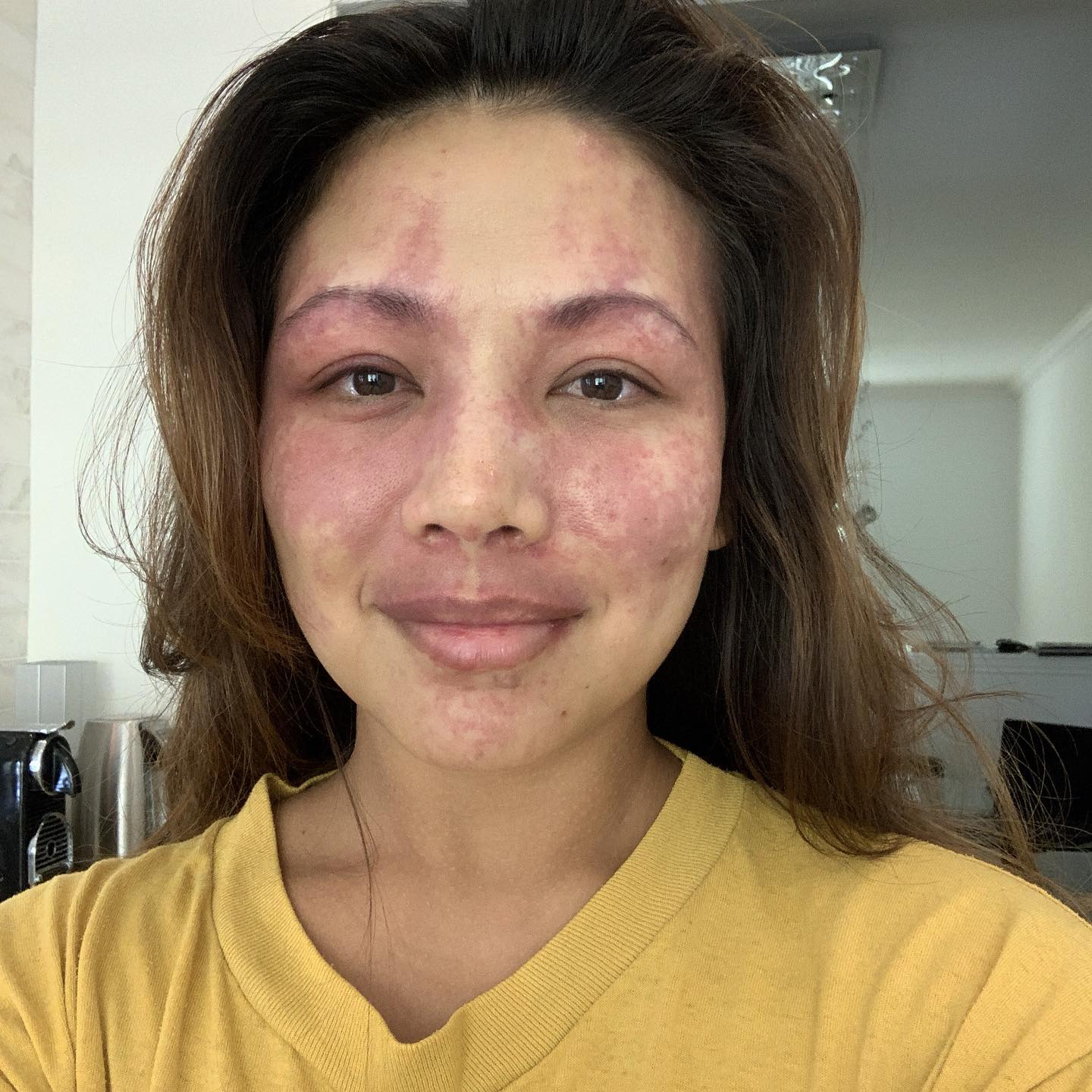 It’s been 5 years since my last pulse due laser treatment. I have seen some tissue thickening on the left side of my face and som pore enlargement in that thickens tissue. This year I’m going to have a pulse dye treatment for maintenance. Hopefully they will go hard at the left side so I can get some relief in pressure.