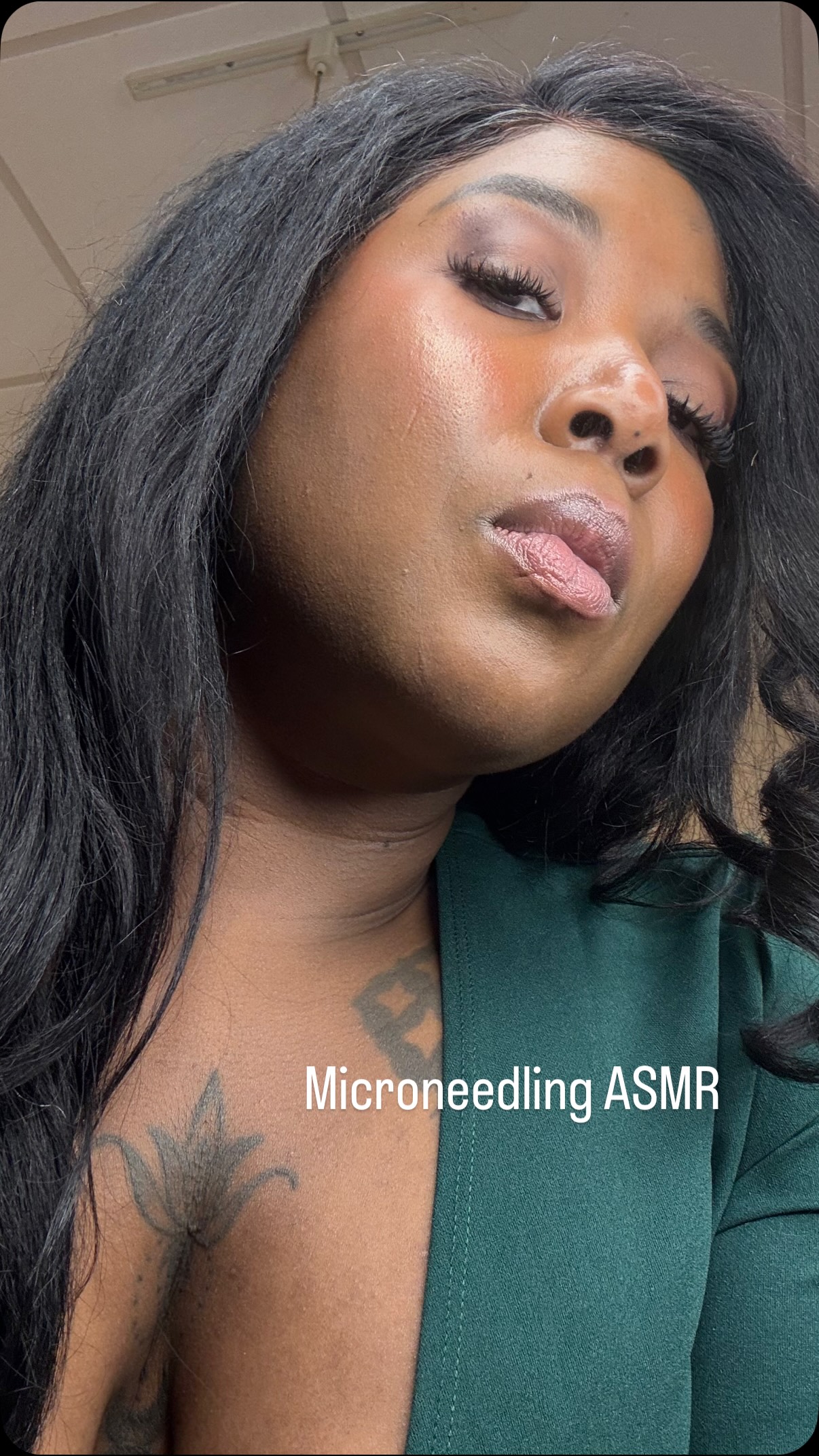 Key Benefits
Collagen Stimulation: The tiny needles create micro-injuries, prompting the skin to produce more collagen and elastin, leading to firmer, plumper skin.
Scar Reduction: Effective for improving the appearance of acne scars, surgical scars, and stretch marks by remodeling the skin.
Anti-Aging: Reduces fine lines, wrinkles (especially around eyes), and sagging skin, restoring a youthful glow.
Pore Minimization: Shrinks enlarged pores for a smoother, more refined appearance.
Improved Tone & Texture: Evens out skin tone, reduces roughness, fades dark spots, and reverses sun damage.
Enhanced Product Absorption: Creates channels for serums and other topical treatments to penetrate deeper into the skin. #kemskin #rfmicroneedling #microneedle