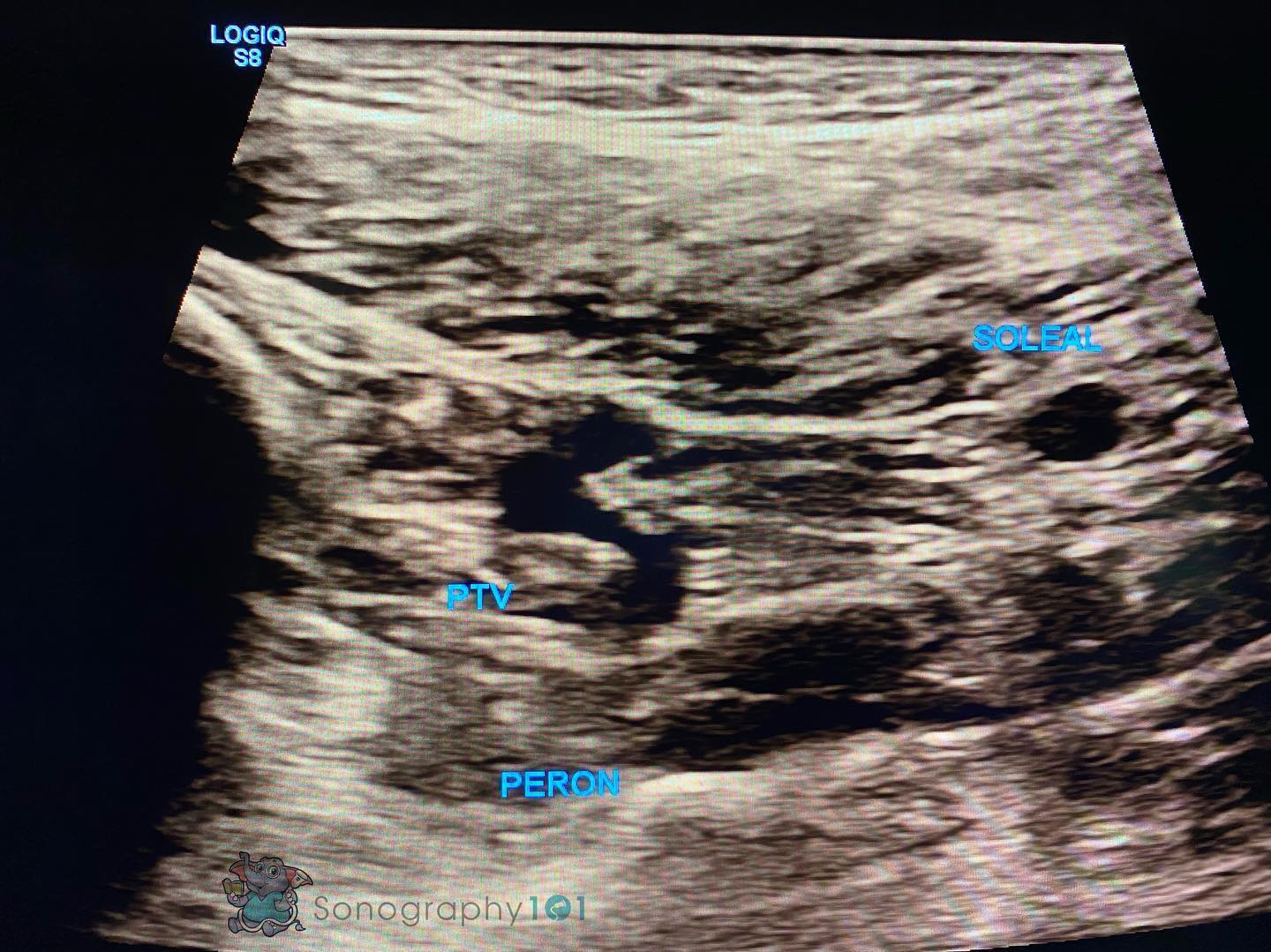 Deep Calf Veins in ultrasound 😍
This is crucial to know in the clinical setting.