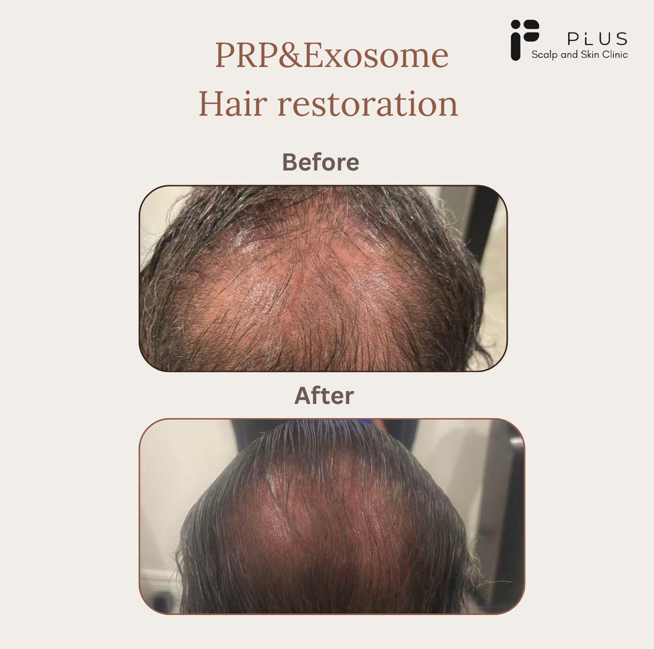 We expertise in combine scalp health treatment ➕ PRP/Exosome procedure ➕ Exclusive Products for your best hair restoration results.
↪️Fewer treatments, fewer costs, less pain! But! Better results, and no more Minoxidil
‼️Professionalism is our priority
📝Book appointment now with us at
@plusscalpandskin
📌227 Glenferrie Rd, Malvern
#melbourne #melbournelife #malvern #scalp #scalptreatment #hair #hairtutorial #injectables #cosmeticinjectables #facelift #faceliftingmassage #antiaging #scalpskincare #skincare #skincareroutine #skin #lipfiller #botoxfacial #skincleansing #hairwash #headspa #facial #guasha #dandruff #dandruffremoval #hairtransplant #hairtransplantaftercaresolutions