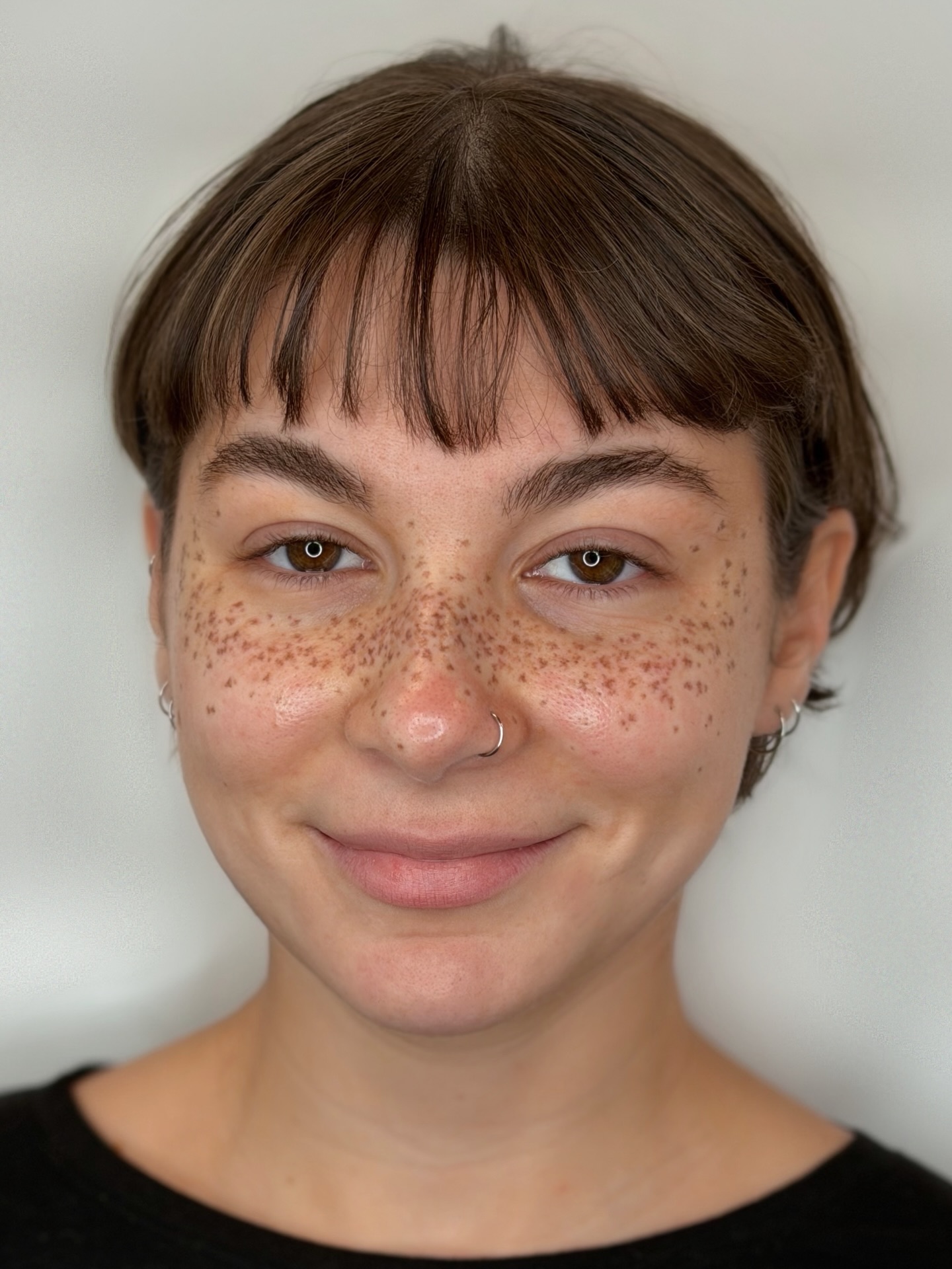 Layering freckles is my favorite ✨
This is session FOUR — building up density slowly for an extreme coverage result that still heals beautifully.
EXTREME COVERAGE FRECKLES.
Now booking January–February