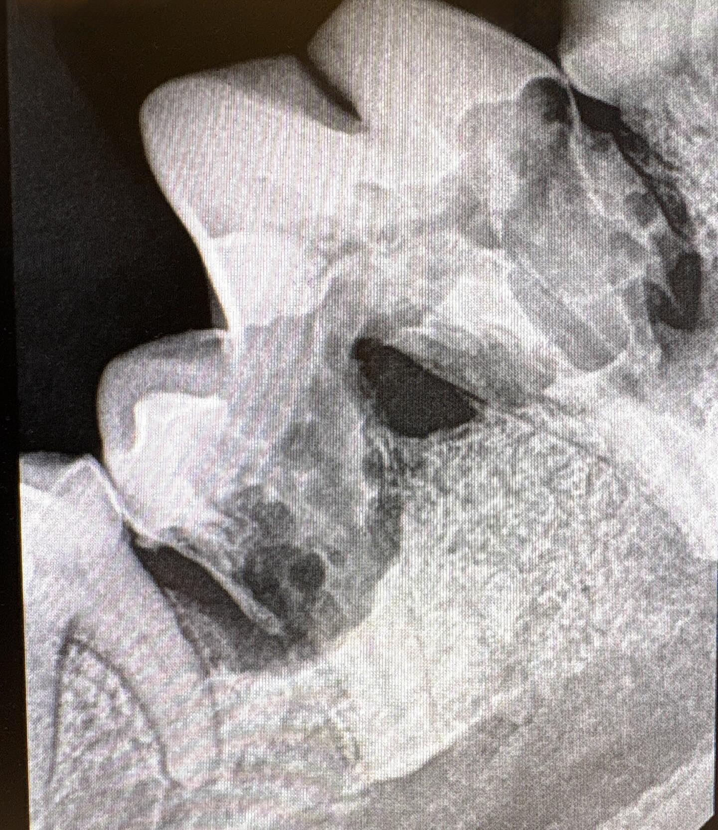 Aua! Zahnweh beim Hund 🤕🦷🐕
Zahnröntgen ermöglicht uns Erkrankungen des Zahnhalteapparates und des Zahnes zu diagnostizieren.
Heute zeigen wir euch ein eindrückliches Röntgenbild, welches die Resorption eines unteren Reisszahnes zeigt.
Das tut weh! Der Zahn ist nun gezogen, die Schmerzen sind weg und dem Hund geht es wieder gut!
@tierarztpraxis_rothenburg
#hundezähne #zahnschmerzenhund #zahnröntgen #zahngesundheit #glücklichehunde
