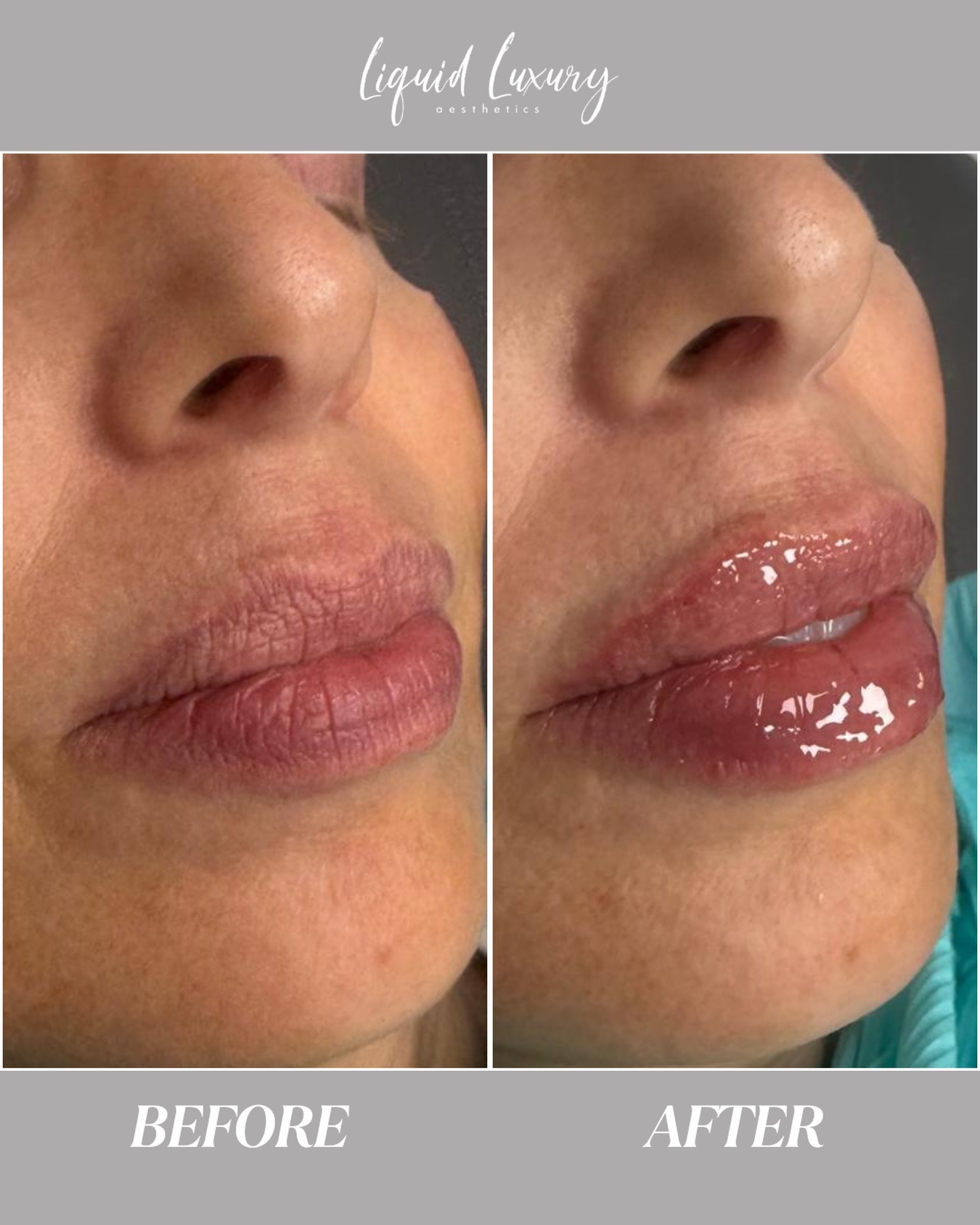 Ready for perfect lips? 💋
Enhance your natural shape, add subtle volume, and get the soft, balanced look you’ve been dreaming of. These results were achieved using Evolysse filler!
Slots are filling up...book yours today! ✨
📞 (631)760-1124
🌐 www.liquidluxuryaesthetics.com
📍 1030 W Jericho Tpke Suite 5 Smithtown, NY 11787
📧 info@liquidluxuryaesthetics.com
👩🏼⚕️ Ina LaRocca-Tocco, FNP-C
🤳TikTok: liquidluxury_aesthetics
#lipfiller #Evolysse #naturallips #medspalongisland #longislandmedicalspa