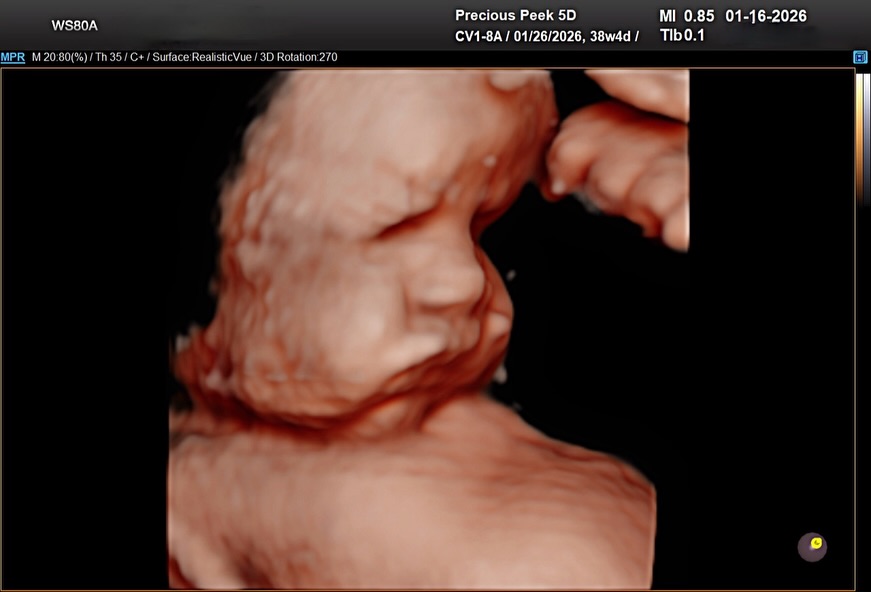 38 weeks + 4 days 🤯
A question I get all the time is:
“Is it too late to get an ultrasound?”
And the honest truth? It’s not a yes or no answer.
It’s kind of like asking, “How long will I be in labor?” Every mom is different, every pregnancy is different, and every baby already has their own personality.
Some babies start playing hide n seek as early as 28 weeks. Others are out here striking full model poses at 38+ weeks. 😂 There’s just no predicting it.
What can be predicted is the effort.
If you know me, you know I’ll try everything: position changes, patience, little tricks, breaks, music, and yes, hydration makes a huge difference. I don’t give up easily.
And even if the photos aren’t perfectly staged, the experience itself is what makes it beautiful. Hearing the heartbeat. Watching those tiny movements. Bonding with your baby before they’re in your arms. (And most of my sessions include a complimentary re-do if baby just isn’t cooperating.)
So when you ask, “Is it too late?”
The honest answer is:
💗 It depends on your baby. 💗
I can’t guarantee perfection.
But I can promise patience, care, effort, and a memory worth having.
And just so you know; I’ve had plenty of moms come in late in the third trimester and leave with absolutely stunning images they cherish forever. 🥹✨
So if you’re wondering… it may not be too late at all. 💕