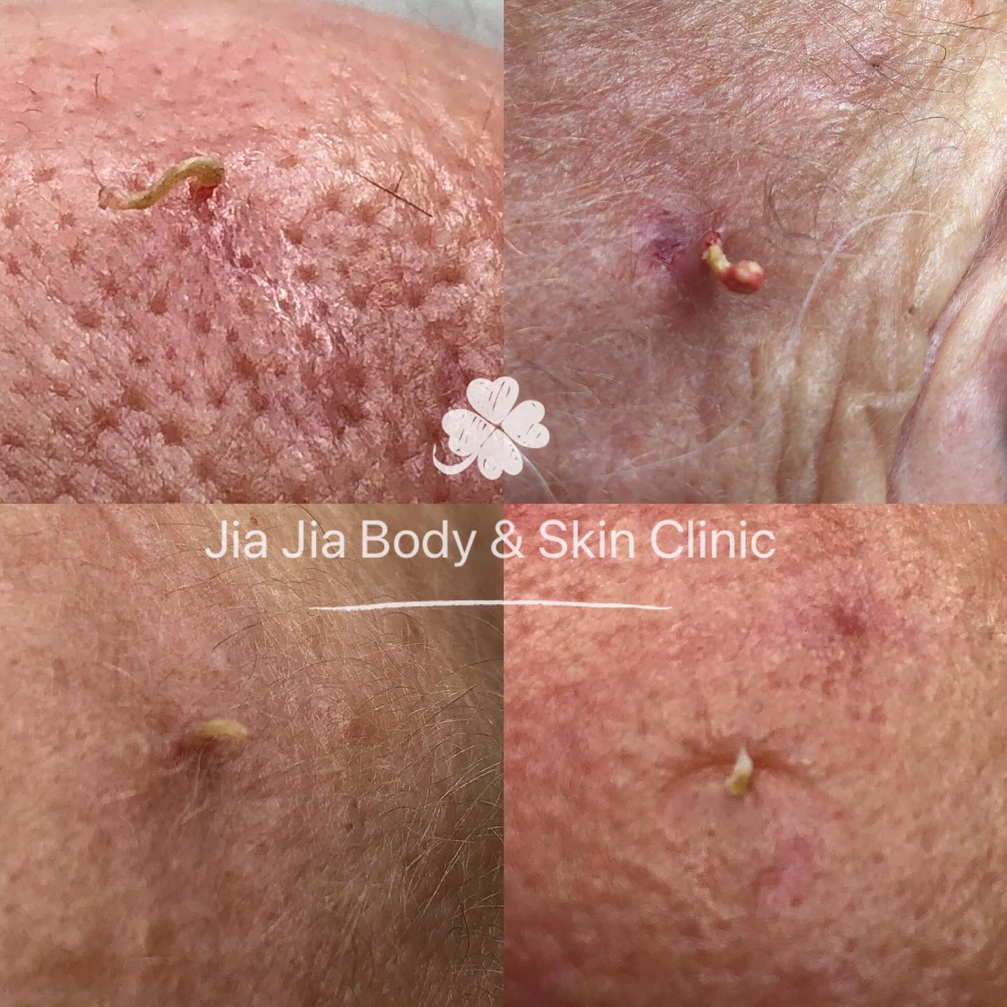 ComedoneĀ occurs when sebaceous gland is clotted with excess of sebum production and result in a plug at the top of the pore.ā£ā£ā£ā£ā£ā£
ā£ā£ā£ā£ā£ā£
ā£ā£Call for an appointment to discuss customizing a treatment protocol which is the best for your skin type.⣠ā£ā£ā£ā£ā£ā£ā£ā£ā£
ā£ā£ā£ā£ā£ā£ā£ā£
Jia Jia Body & Skin Clinic
āļø 02 98083880 or SMS 0401697198
#blackhead #comedone #extractions #acnetreatment #laser #skincare #blemishes #acne #skintagremoval #drpimplepopper #clearskin#sydneyacne #acnesydney