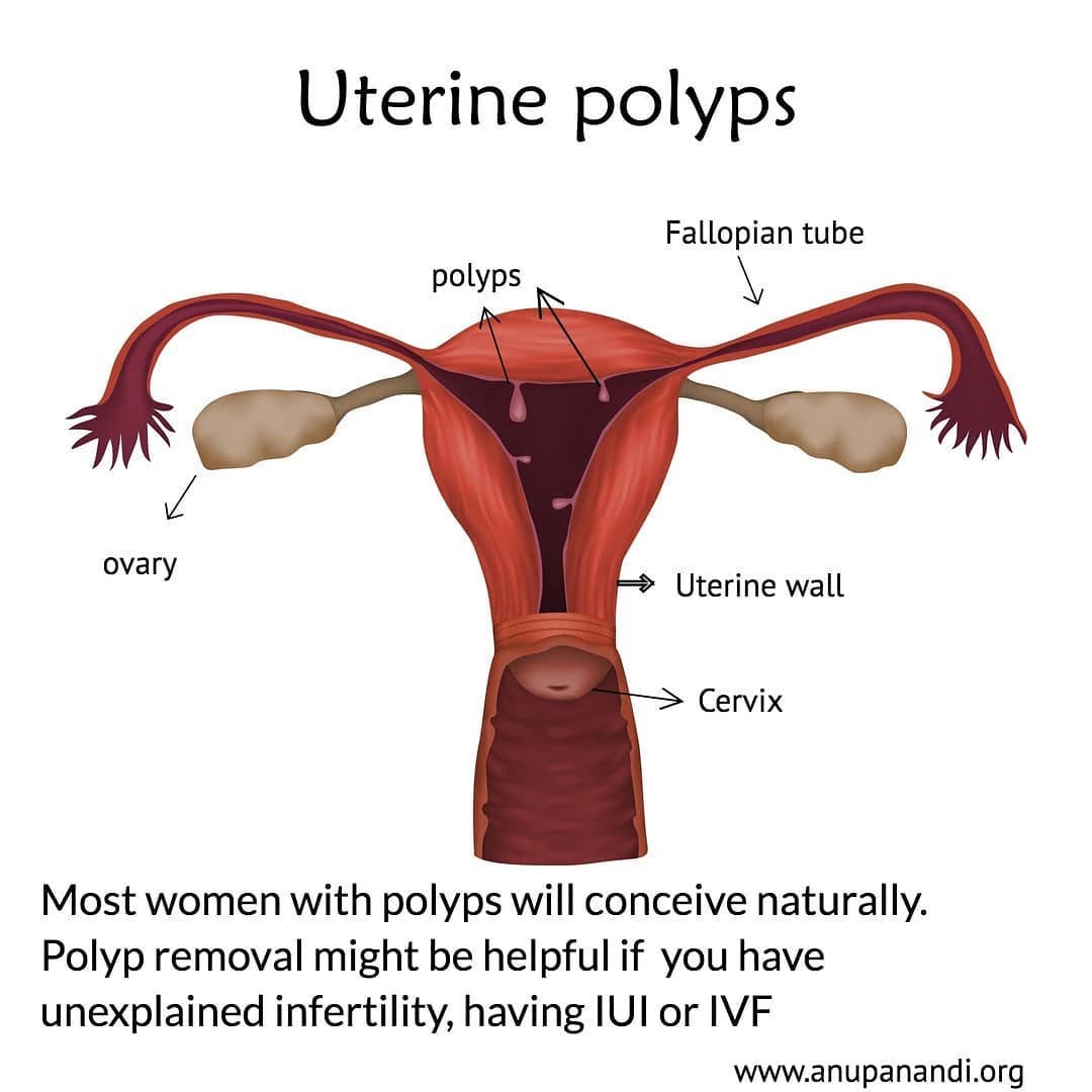 Can uterine polyps cause infertility?
Read more: www.anupanandi.org
#infertility #fertilityawareness #fertility #polyp #infertilityawareness #iui #ivf #ivfjourney #polypterus