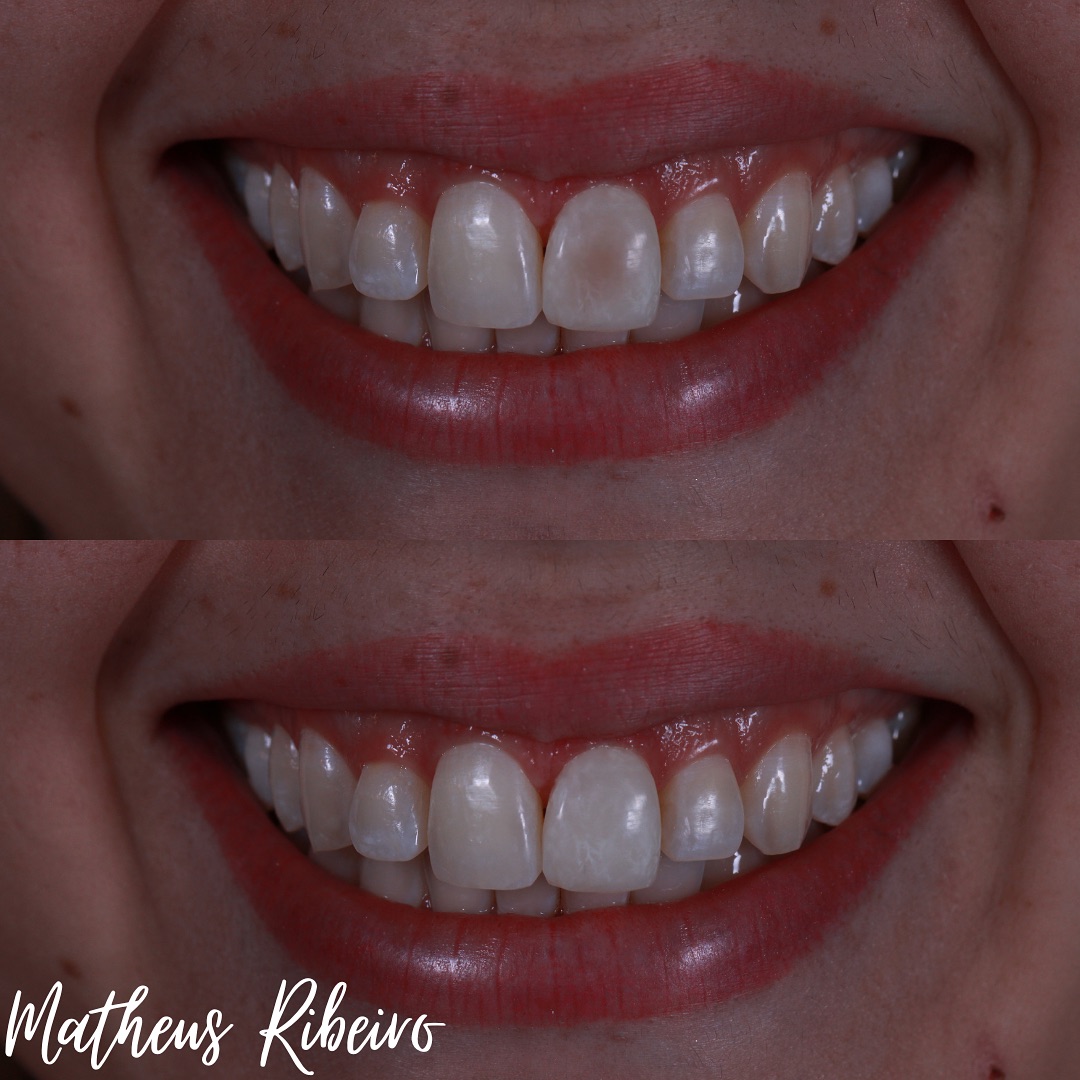 Tratamento estético de apenas 1 faceta, é sempre complexo pois é necessário buscar semelhança com o outro dente.