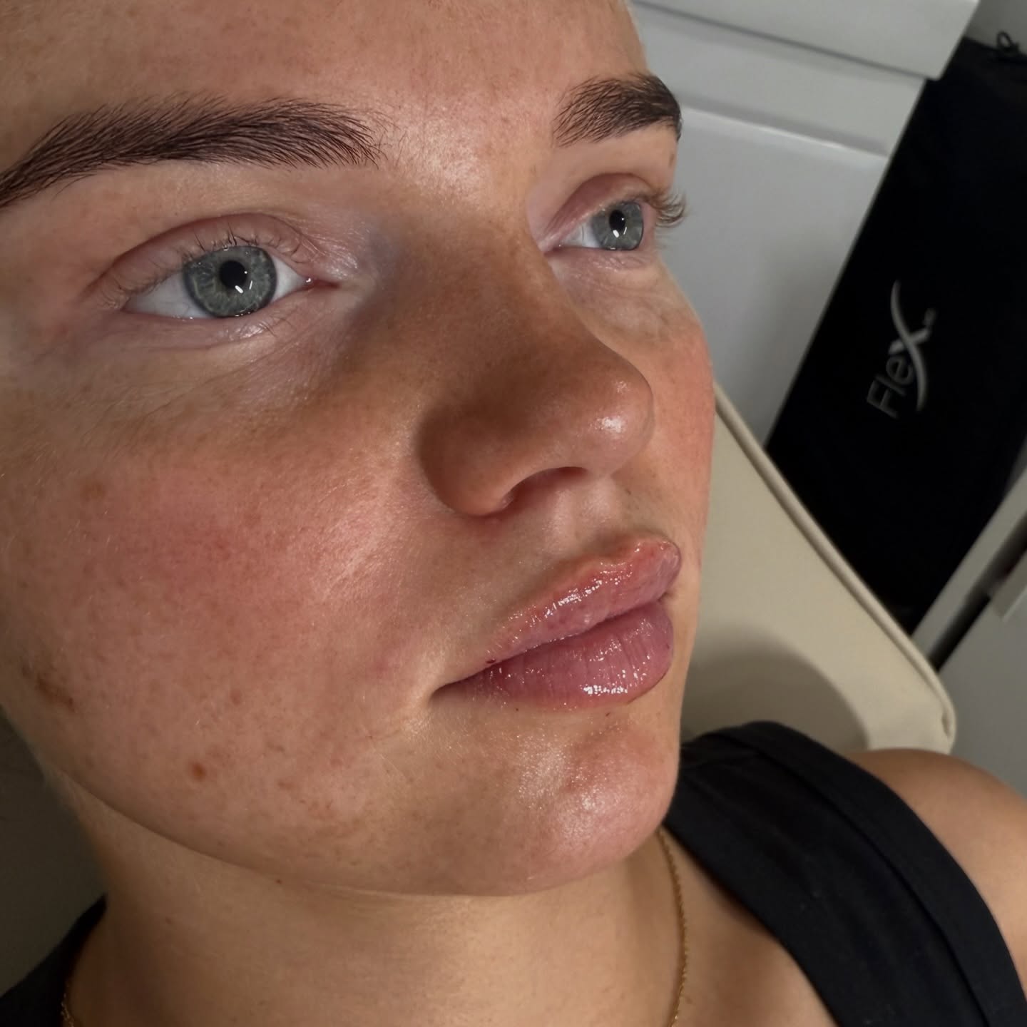 Everyone’s lips are different.
Natural lip shape is influenced by things like facial structure, muscle movement, and how the lips sit in relation to the rest of the face. Some people have a more defined cupid’s bow, others more fullness through the body of the lip, and some have subtle natural asymmetries, all of which are completely normal.
This is why at Enhanced by Darcie, we don’t follow trends. Every treatment should be tailored to what suits each patient’s unique features, creating balance and harmony rather than trying to fit a “one-size-fits-all” look.
*this is for educational purposes only. All treatments are determined suitable during a consultation in clinic. Photo Consent obtained