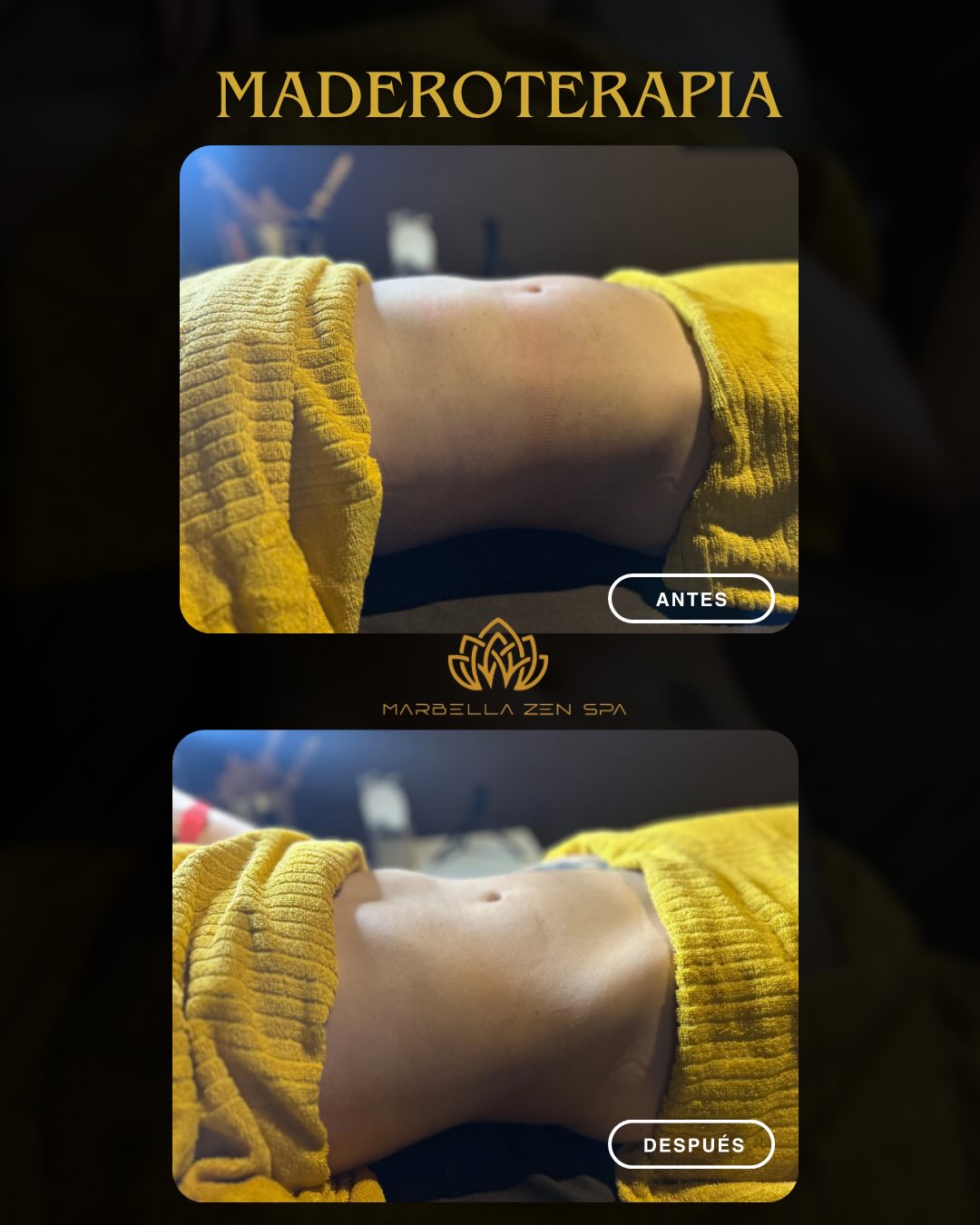 Los resultados hablan por sí solos! 🔥
La maderoterapia no es solo un masaje, es una técnica milenaria que ayuda a:
✨ Reducir medidas y grasa localizada.
✨ Eliminar la retención de líquidos (adiós hinchazón).
✨ Tonificar y mejorar la apariencia de la piel (celulitis, ¡fuera!).
✨ Moldear tus curvas de forma natural.
¿Estás lista para empezar tu propio cambio? No esperes a que te lo cuenten, vívelo tú misma. 🪵💪
📩 Escríbeme por DM para agendar tu cita o pedir información.