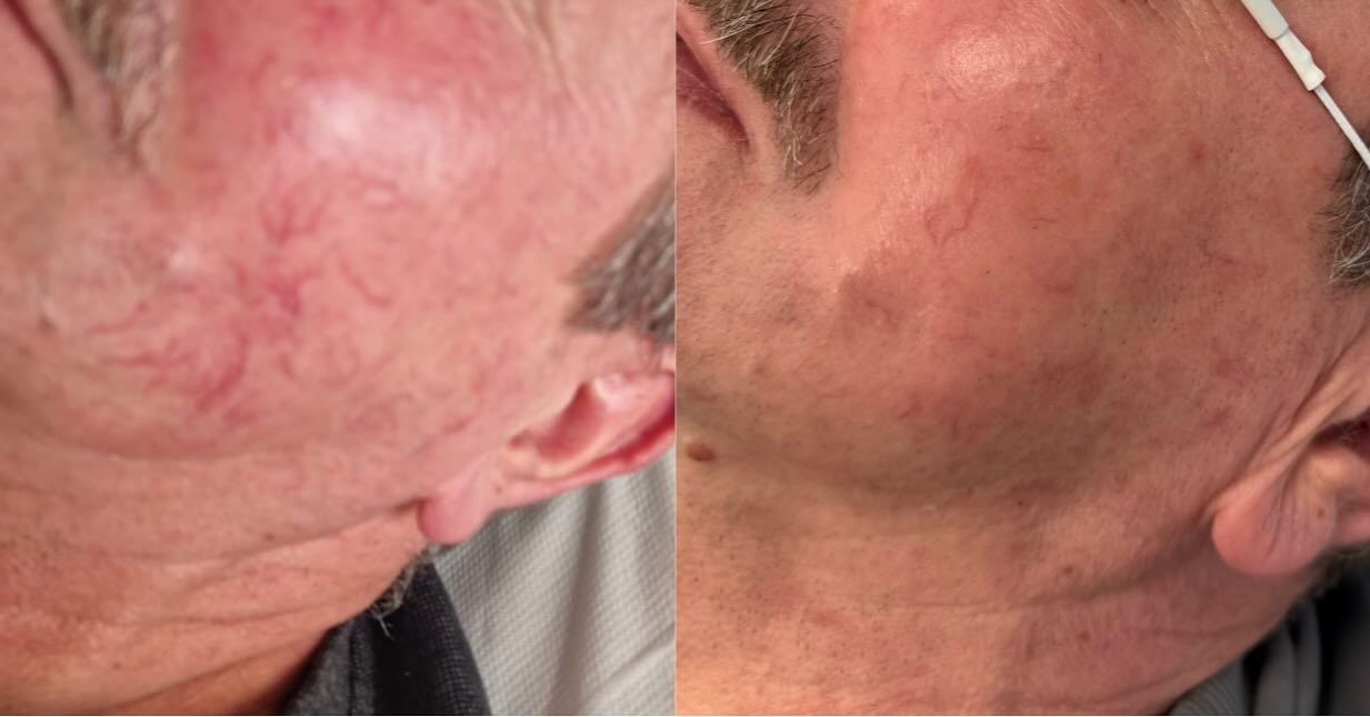 Likwidacja rumienia i naczynek światłem szerokopasmowym.✨🫶
Zapraszamy 🤍
📞693-101-233