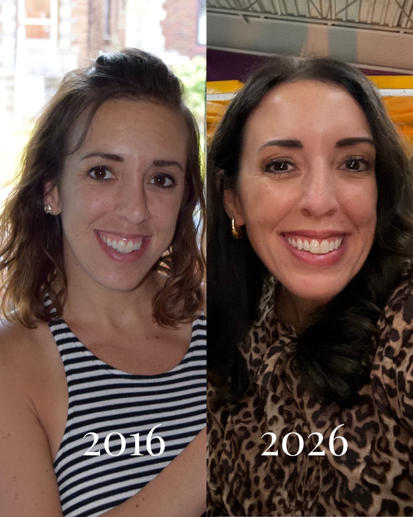 2016 vs 2026
I struggled with melasma during each pregnancy (which you can see in the 2016 pic) and beyond. I also wasn't able to get Botox for several months between being pregnant and breastfeeding. Once I emerged from baby life, I put a concerted effort back into my skin.
.
Here's everything I have done from 2016 ---> 2026, no gatekeeping:
āØdaily use of medical grade skincare: Vitamin C, retinol and mineral based SPF
āØlasers at least once a year (BBL, Moxi, Clear and Brilliant )
āØBotox/ Dysport every 3-4 months
āØseries of 3 microneedling sessions and then quarterly maintenance (have added on exosomes and PDRN for a few)
āØtiny amount of filler to top lip and cheeks
⨠dermaplaning every 4-6 weeks
āØmedical grade facials and chemical peels a few times a year
āØInvisalign
āØred light therapy
āØmicrobladed my eyebrows (a good set of eyebrows is life changing!)
.
It's all about consistency but it starts with a good skincare regimen!
.
Not sure where to start? Book your complimentary consultation!
.
āļøBOOK WITH ME āļø
š»www.allure-dbq.com
š 563-258-4698
š§ info@allure-dbq.com
.
āļøFOLLOW MEāļø
Nicole Powers, ARNP, AGNP-BC
@nicolepowers_np
Allure Aesthetics + Wellness
@allure_iowa
#nurseinjector #nursepractitioner #iowa