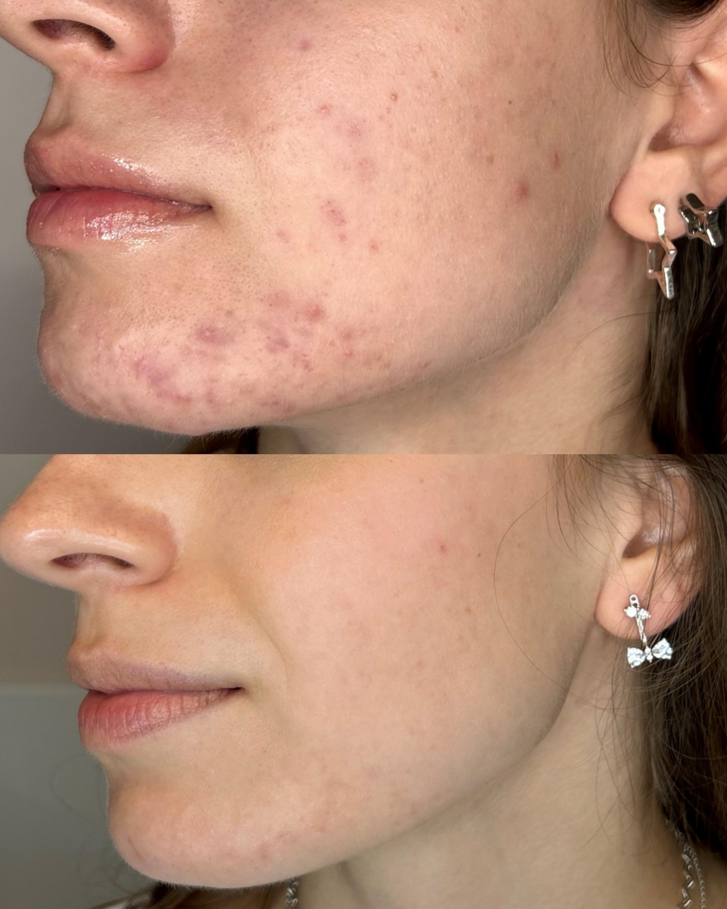 L’acne non è solo un problema estetico: è una patologia della pelle e, come tale, va trattata nel modo giusto.
Ogni acne è diversa per causa, età, tipo di pelle e stile di vita: ecco perché le soluzioni “uguali per tutti” spesso non funzionano.
🔬 Una valutazione dermatologica personalizzata permette di individuare il trattamento più efficace, prevenire cicatrici e migliorare la salute della pelle nel tempo.
👉 Affidarsi allo specialista significa curare l’acne, non coprirla.
#Acne #Dermatologia #CuraPersonalizzata #PelleSana #SkincareConsapevole Dermatologo