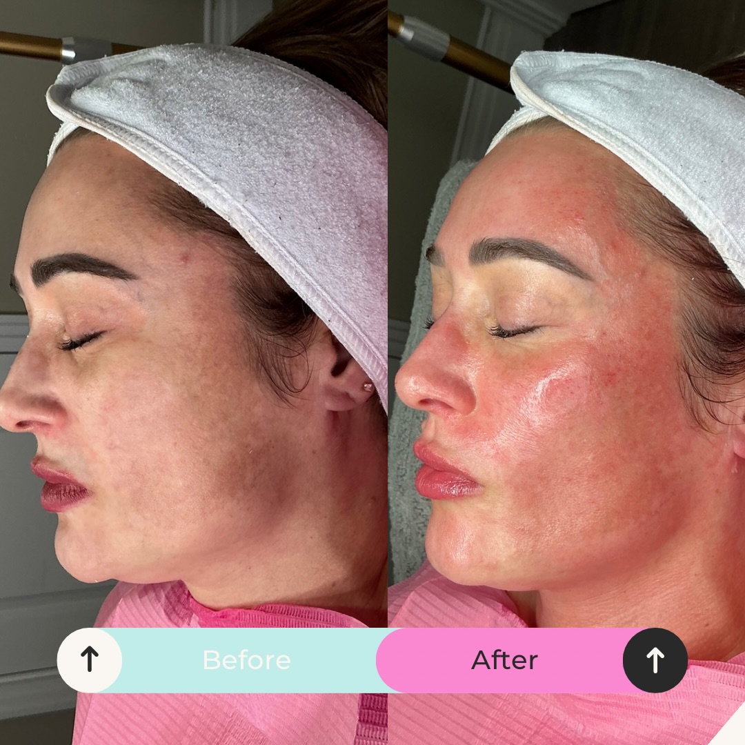 Dull & dehydrated —-> Gorgeous & glowy ✨
Before and immediately after her microneedling session with the Derma 2.0 Derma Bio serum, stunning! 🤩