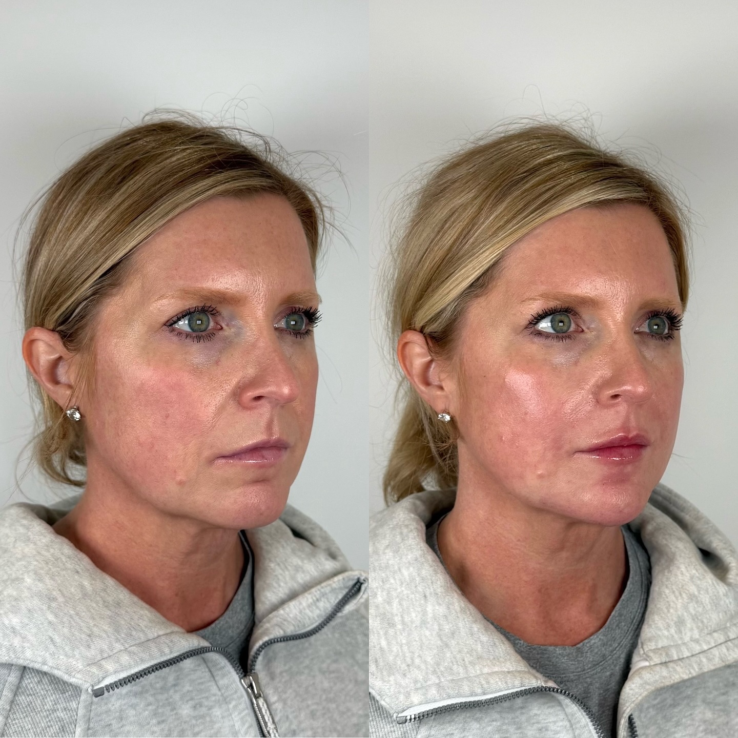 This is artistry, not overfilling.
Not puffy.
Not obvious.
Not “done.”
Just a face that looks brighter, softer, and more in harmony than before.
This patient trusted us with full facial balancing, meaning we didn’t chase one line or one area. We looked at the entire face and treated 7 key points (temples, mid-cheek, nasolabial folds, chin, chin shadow, mental crease and lips) to restore structure, lift, and light where time had quietly taken it.
When filler is placed with an expert eye for proportion and facial flow, it doesn’t change who you are. It just restores what’s been lost.
If you’ve ever looked in the mirror and thought, “I just want to look more rested… more like myself again,” this is exactly what we do.
✨ Book a facial balancing consult and let’s create your most refreshed version.
#FacialBalancing #FillerDoneRight #NaturalAesthetics #DFWInjector #FACaesthetics #ArgyleTX #FlowerMoundTX #SubtleEnhancement #BespokeAestheticMedicine