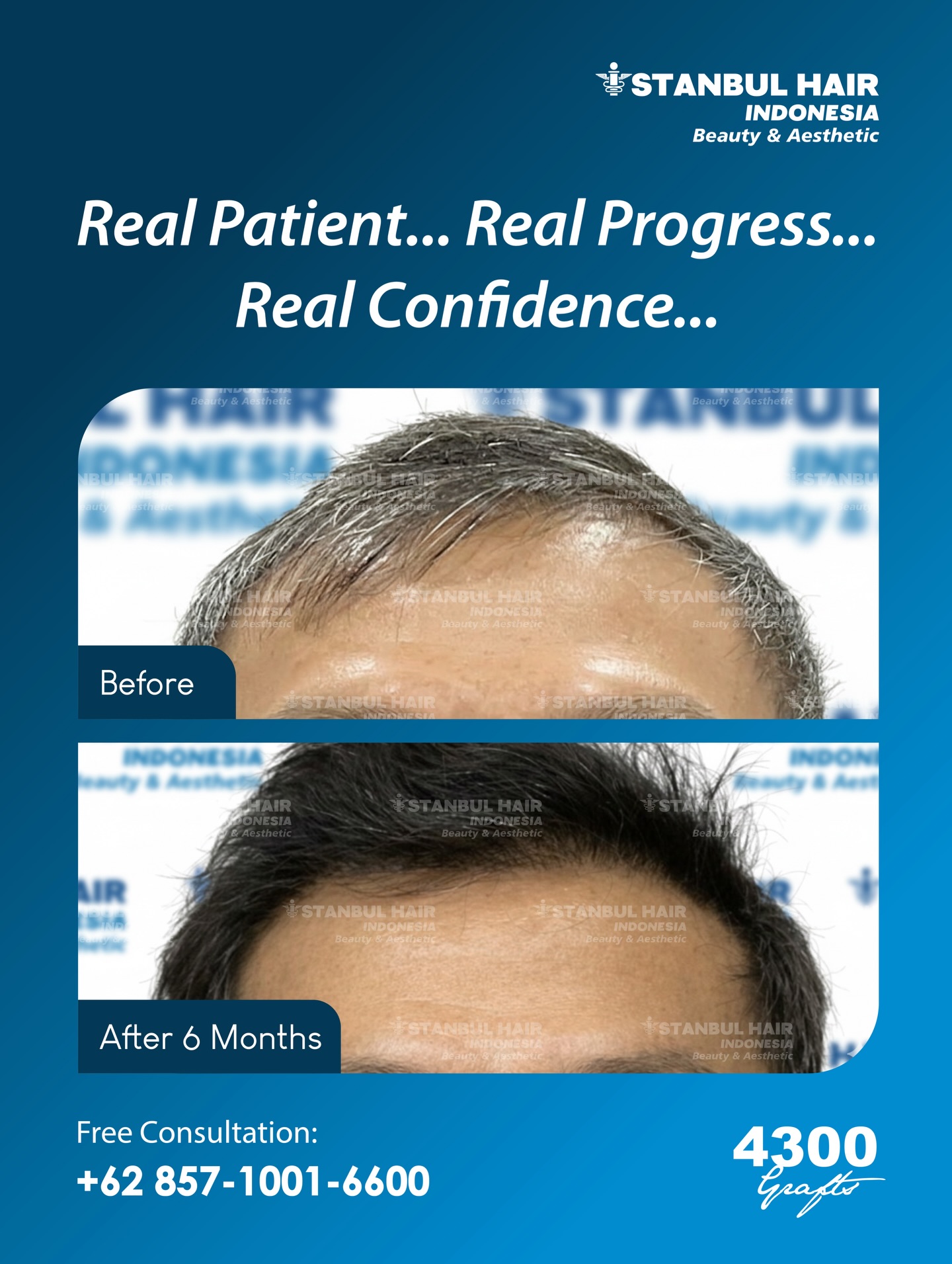 💼 4.300 grafts — 6 bulan pasca hair transplant
Rambut terlihat lebih tebal, perubahan semakin nyata.
Kepadatan tumbuh natural dengan hairline yang rapi, sesuai desain personal sejak awal tindakan.
Dari Jakarta, menuju kepercayaan diri baru.
⸻
💼 4,300 grafts — 6 months post hair transplant
Hair looks visibly thicker as progress becomes clear.
Natural density and a refined hairline, precisely designed from day one.
From Jakarta, for renewed confidence.
📍 Istanbul Hair Indonesia
📞 +62 857-1001-6600
#IstanbulHairIndonesia #4300Grafts #6MonthsResult #HairLooksThicker #NaturalHairline
