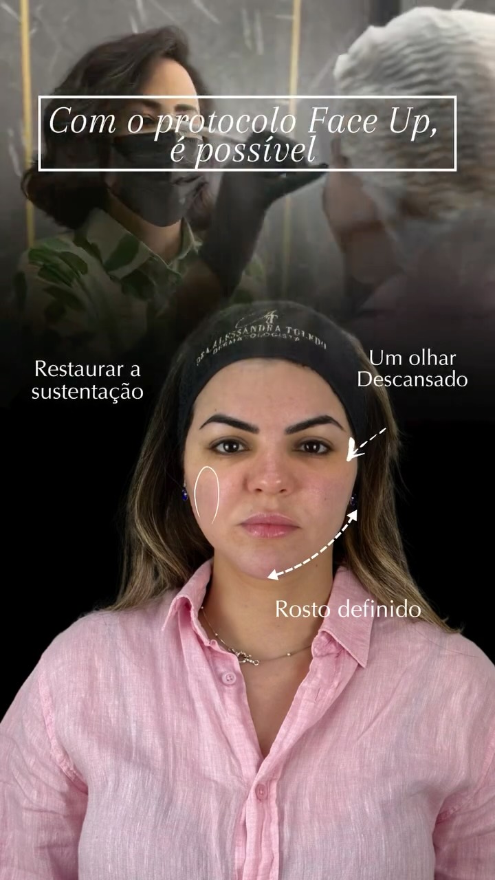 Ela não parecia cansada por falta de descanso.
O que existia aqui era queda dos compartimentos faciais, flacidez progressiva e o início do derretimento facial quando o rosto perde sustentação, o olhar pesa e a expressão fica triste, mesmo sem estar.
O Face Up atua exatamente nesse ponto:
não é sobre “encher”, é sobre reposicionar estruturas, devolver suporte e restaurar contornos, respeitando a anatomia e a naturalidade.
🔹 Olhar mais leve e aberto
🔹 Redução da flacidez
🔹 Contorno facial mais definido
🔹 Expressão descansada, sem exageros
Resultado que não transforma quem você é.
Resultado que devolve o que o tempo levou, com técnica, estratégia e precisão.
Quando o rosto não reflete mais a sua energia, o problema não é cansaço.
É estrutura.
📍 Avaliação individualizada
📩 Agende sua consulta