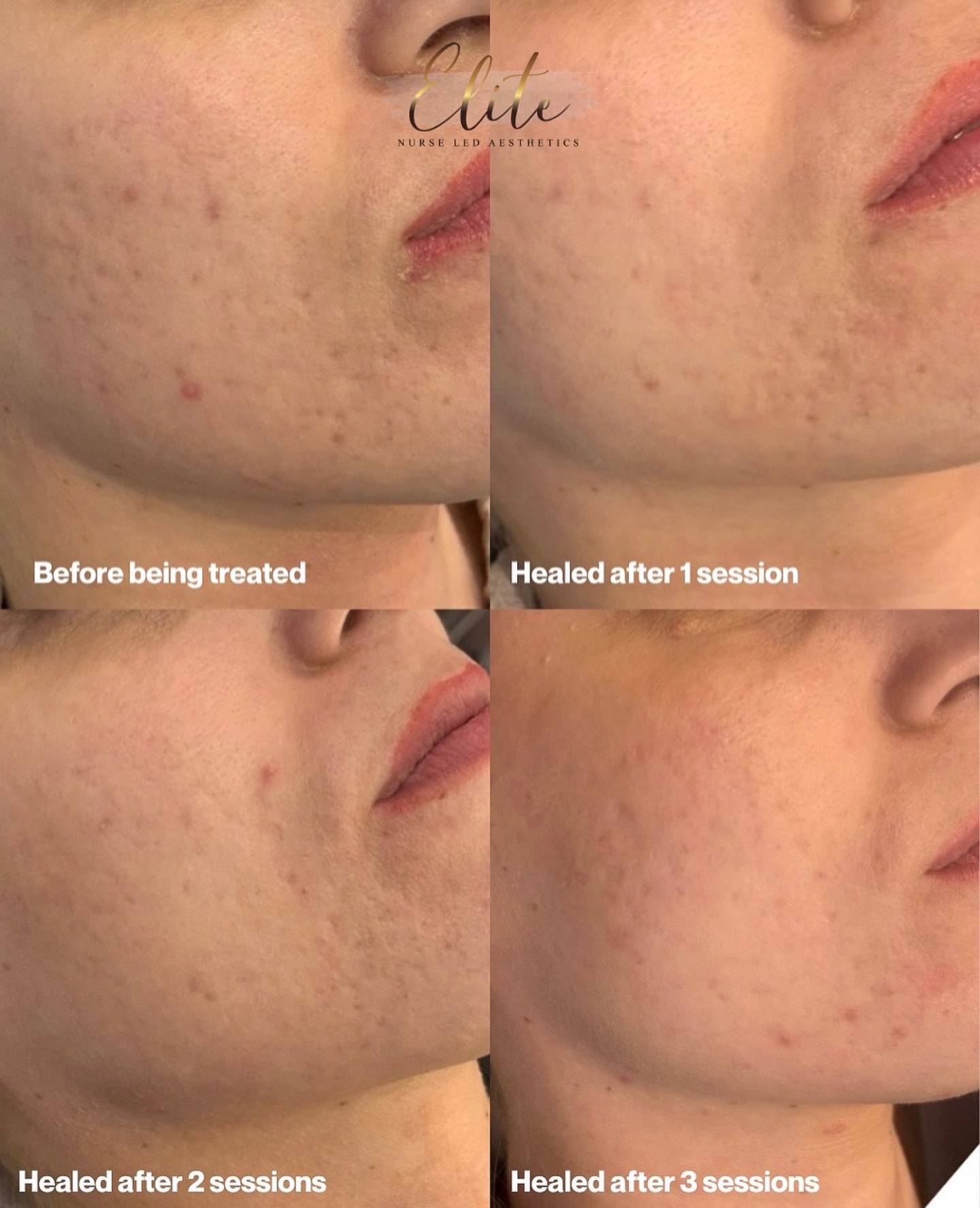 Dermapen Microneedling ✨🖊️
One of the most powerful skin treatments for achieving a smoother, clearer, more youthful complexion — all with minimal downtime 🙌
The Dermapen works by creating tiny micro-injuries in the skin, triggering your body’s natural healing response to boost collagen and elastin production 💥
🔍 Who is it for?
✔️ Acne scars & breakouts
✔️ Enlarged pores
✔️ Fine lines & wrinkles
✔️ Stretch marks
✔️ Pigmentation & uneven tone
✔️ Dull, tired skin
This treatment is ideal for anyone looking to revive their skin from within — targeting concerns without harsh peels or lasers. Results improve over time for that long-lasting glow 💫