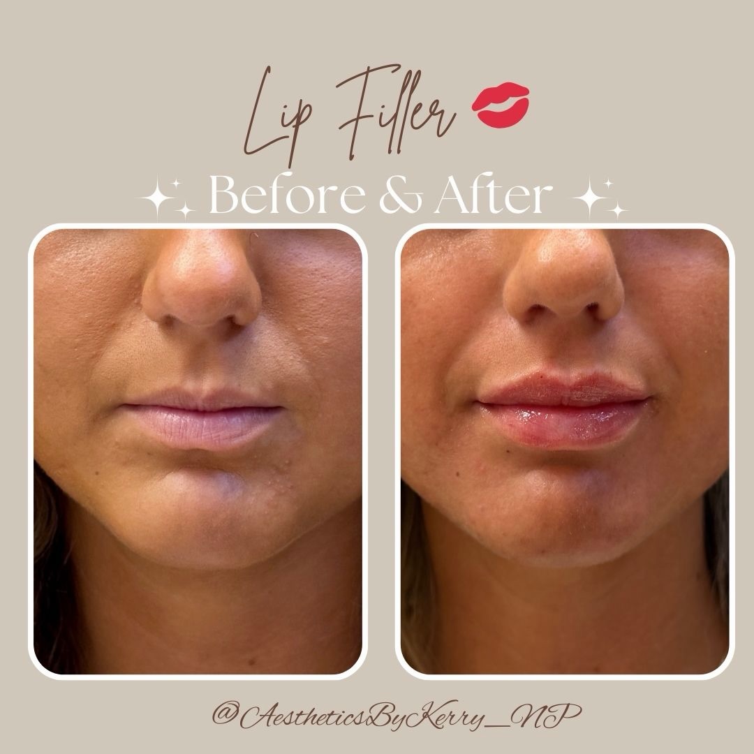 Lip filler gets a bad rap—but when done correctly, it doesn’t make you look done. It enhances your natural features, restores balance, and lets your beauty speak for itself! 💋
Book a personalized lip assessment. Link in bio! ✨💉🤍
📍6279 W. Sample Rd. Suite 305
Coral Springs, FL. 33067
📲 (954)-478-7225
👩🏼💻 www.vitalhealing247.com
.
.
.
#liptransformation #naturallook #beautytrends #injectables