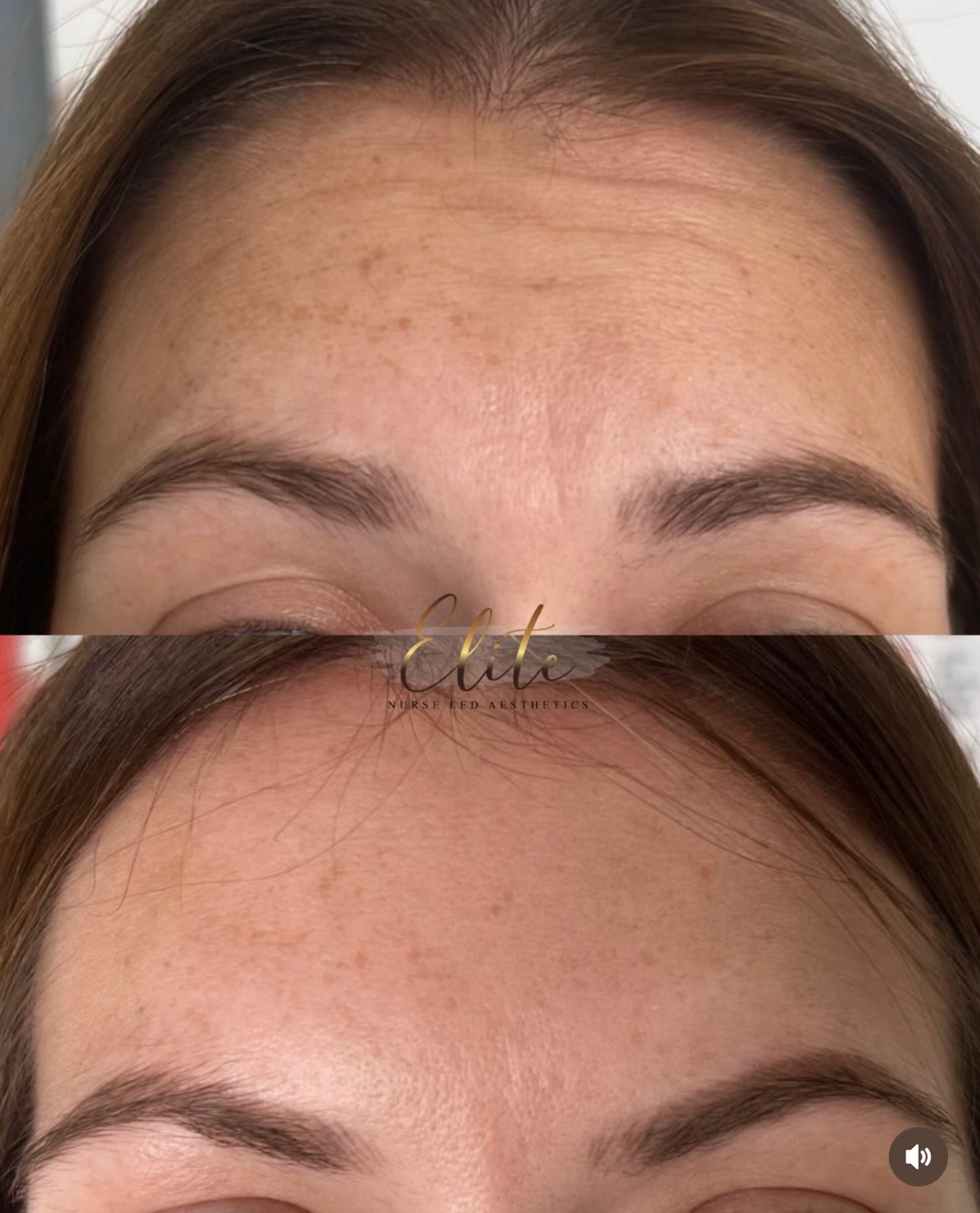 Prevent fine lines before they even start with anti-wrinkle treatment.
This treatment targets forehead wrinkles, helping to relax the muscles and keep your skin smooth and youthful.
What it does for you:
• Prevents deep forehead lines
• Keeps your skin smooth and refreshed
• Offers a natural, youthful look without the freeze
Start early and stay ahead of those fine lines!
Book your anti-wrinkle treatment today and keep your forehead wrinkle-free.
#aesthetics #aestheticsyorkshire #aestheticswakefield #aestheticswakefieldyorkshire #skincareyorkshire