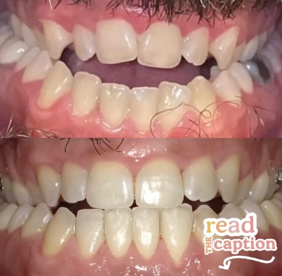 Originally this patient came to me with a complaint about a silver tooth that was aesthetically displeasing. Somehow we ended up here… The Patient needed comprehensive orthognathic surgery to expand his upper jaw. He’s had a severe open bite ever since he could remember, as seen in the before photo (apologies for the poor quality of this image). By the time this patient came to me he was too far into adulthood for this type of surgery to be an option. However, he was very motivated to try anything to close his bite some. I suggested Invisalign with expectations being much lower than the final result. We were able to achieve a lot of closure between his upper and lower anterior teeth. The patient was very compliant and wore his rubber bands on his brackets every chance he could, greatly contributing to the success of his treatment. He was more than thrilled with the outcome as every Dentist in the past told him there was nothing he could do but surgery. Full disclosure… like i said before, to achieve optimal aesthetic results he needed severe painful surgery where his mouth would’ve been glued shut for three weeks. I’m so thrilled we were able to achieve even this! Nothing made me happier to see the joy in this patient’s face with his final outcome. #invisalign#openbites#orthodontictreatment#dcdentist#pahlavanidental