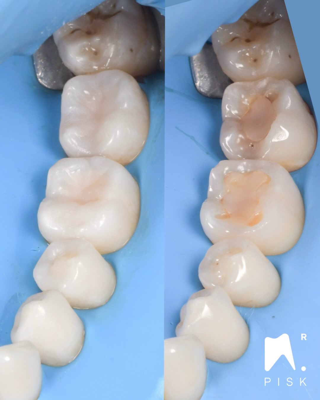 🇫🇷
Injection technique – Posterior & palatal additive approach
Cas d’usure légère liée à un bruxisme nocturne.
La prise en charge a combiné :
• Overlays molaires et prémolaires
• Facettes palatines sur les dents antérieures maxillaires
Objectifs du traitement :
– Restaurer les volumes perdus
– Protéger les structures dentaires
– Retrouver une fonction stable et durable
👉 À mon sens, les techniques de composites guidées (injection) ouvrent une nouvelle porte d’indication dans le traitement des usures légères à modérées, dans une approche 100 % additive et respectueuse des tissus.
Les composites fluides de nouvelle génération présentent aujourd’hui des taux d’usure extrêmement faibles, permettant de considérer ces restaurations comme des traitements définitifs, et non plus comme des solutions temporaires.
⸻
🇬🇧
Injection technique – Posterior & palatal additive approach
Case of mild tooth wear associated with nocturnal bruxism.
Treatment included:
• Molar and premolar overlays
• Palatal veneers on maxillary anterior teeth
Treatment goals:
– Restore lost tooth structure
– Protect dental tissues
– Achieve long-term functional stability
👉 In my opinion, guided composite techniques (injection) open a new indication pathway for the treatment of mild to moderate tooth wear, using a fully additive and tissue-preserving approach.
New-generation flowable composites now show very low wear rates, allowing these restorations to be considered definitive treatments rather than temporary solutions.